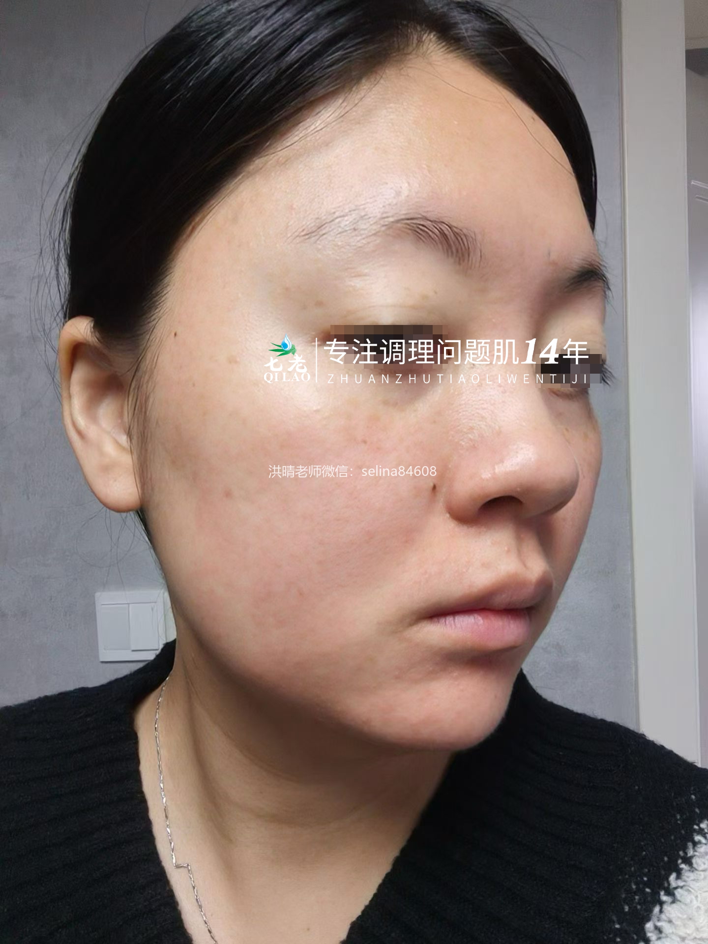 七老激素脸玫瑰皮修护案例