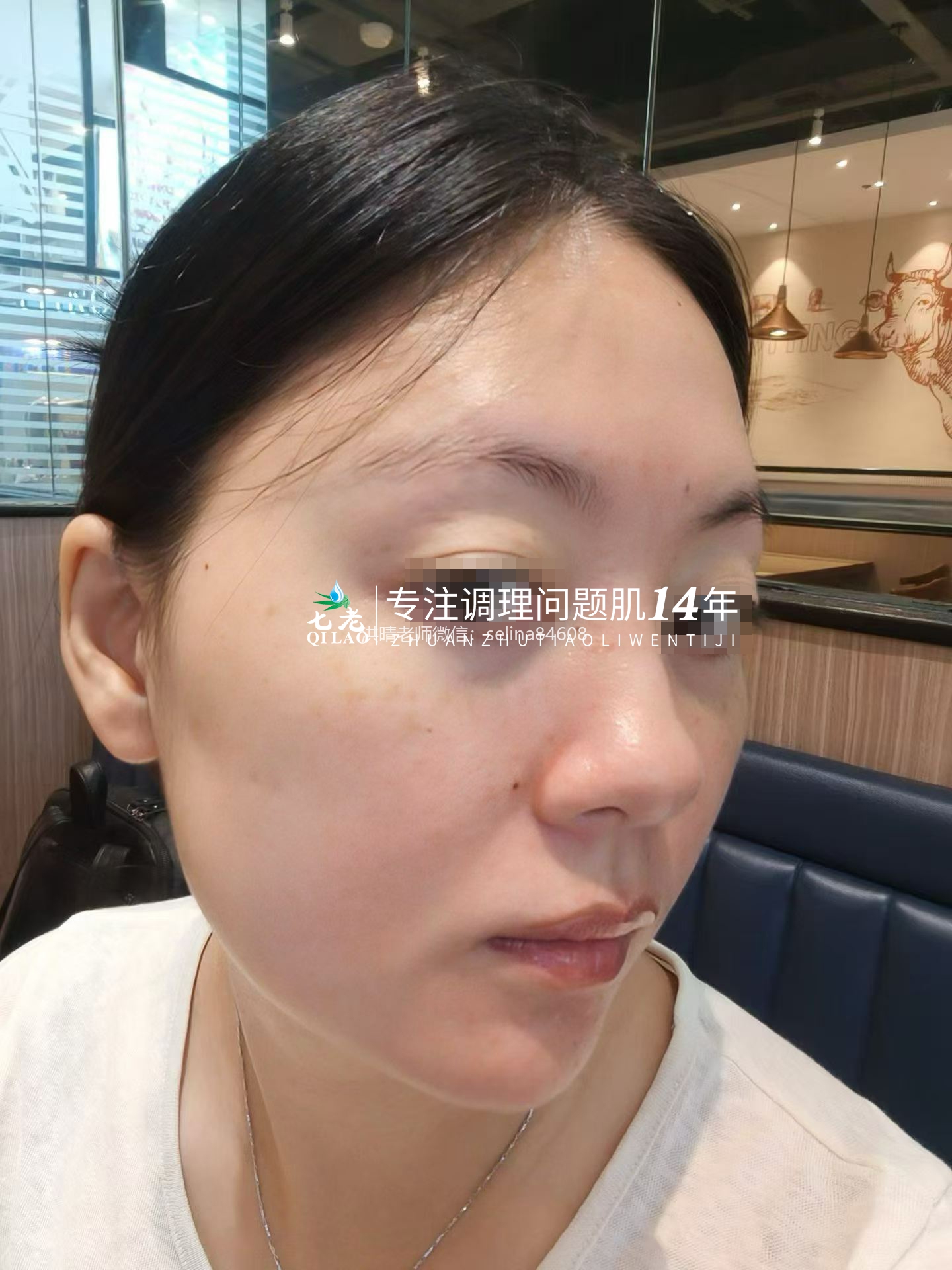 七老激素脸玫瑰皮修护案例