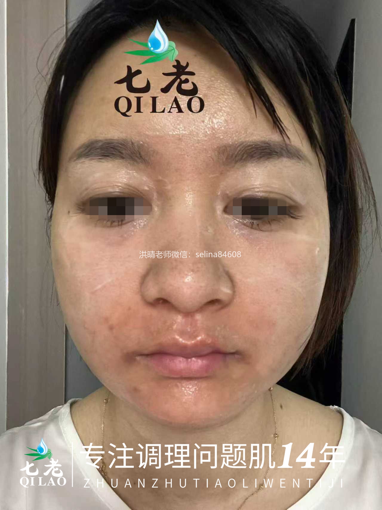 七老皮肤反复过敏红肿痒疹子修护案例