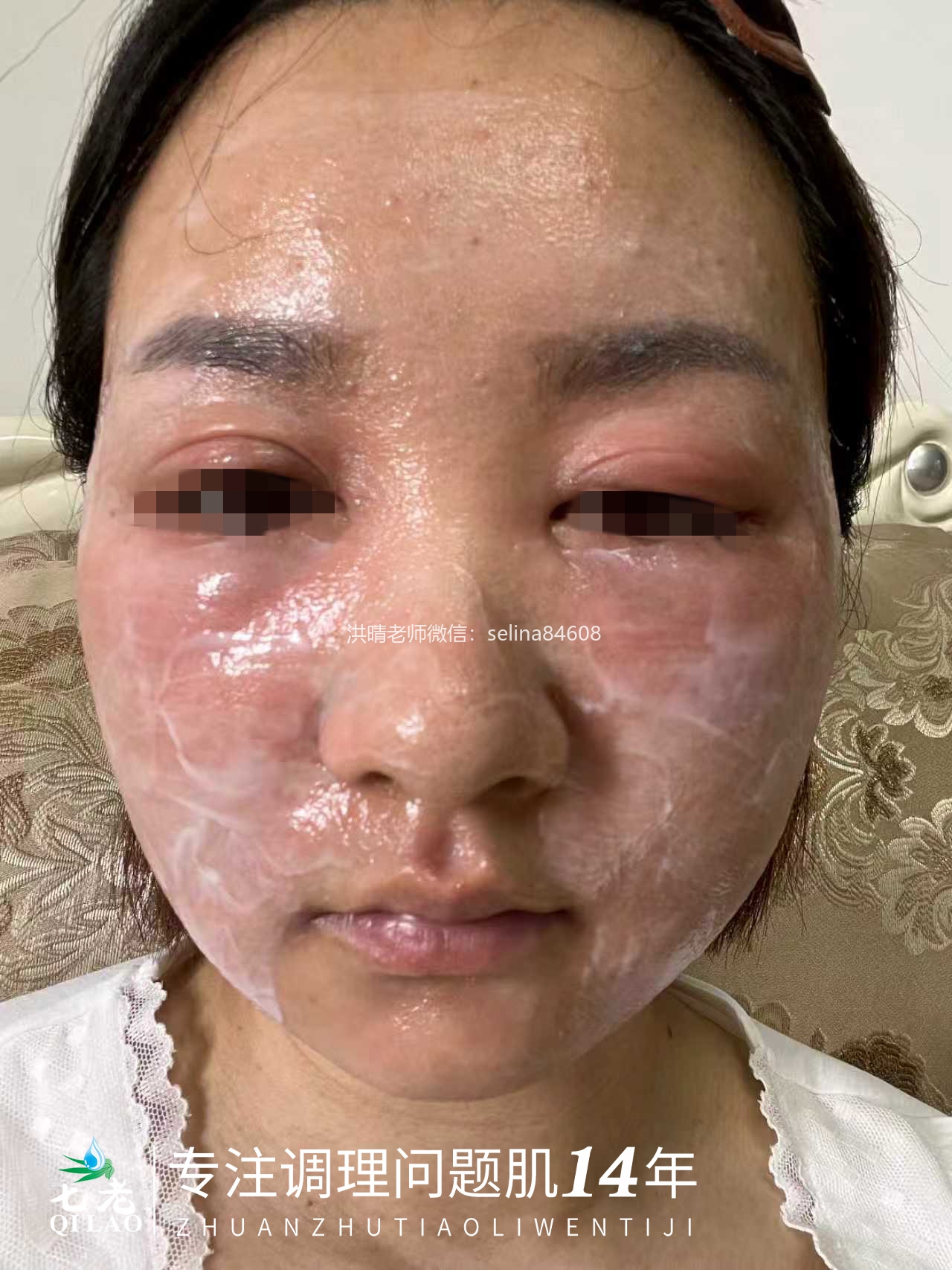 七老皮肤反复过敏红肿痒疹子修护案例