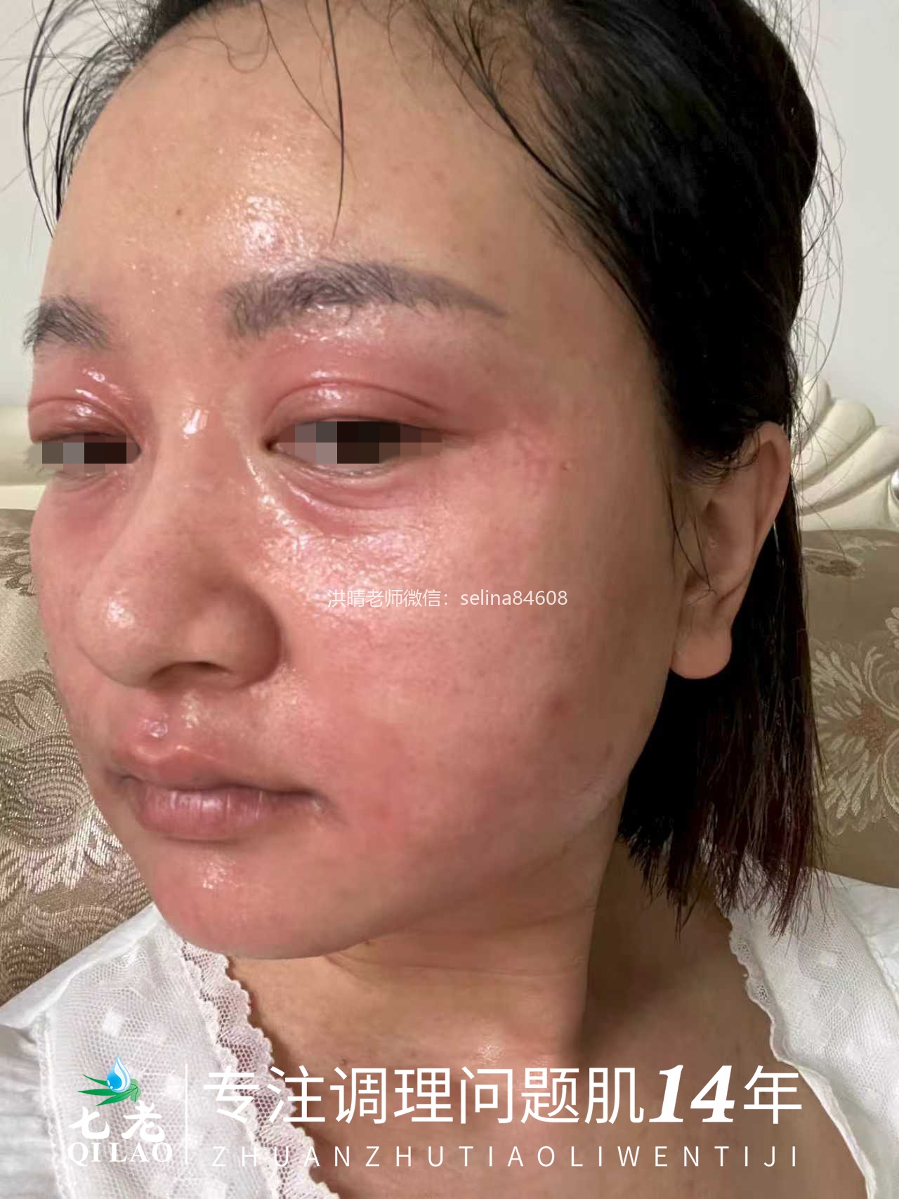 七老皮肤反复过敏红肿痒疹子修护案例