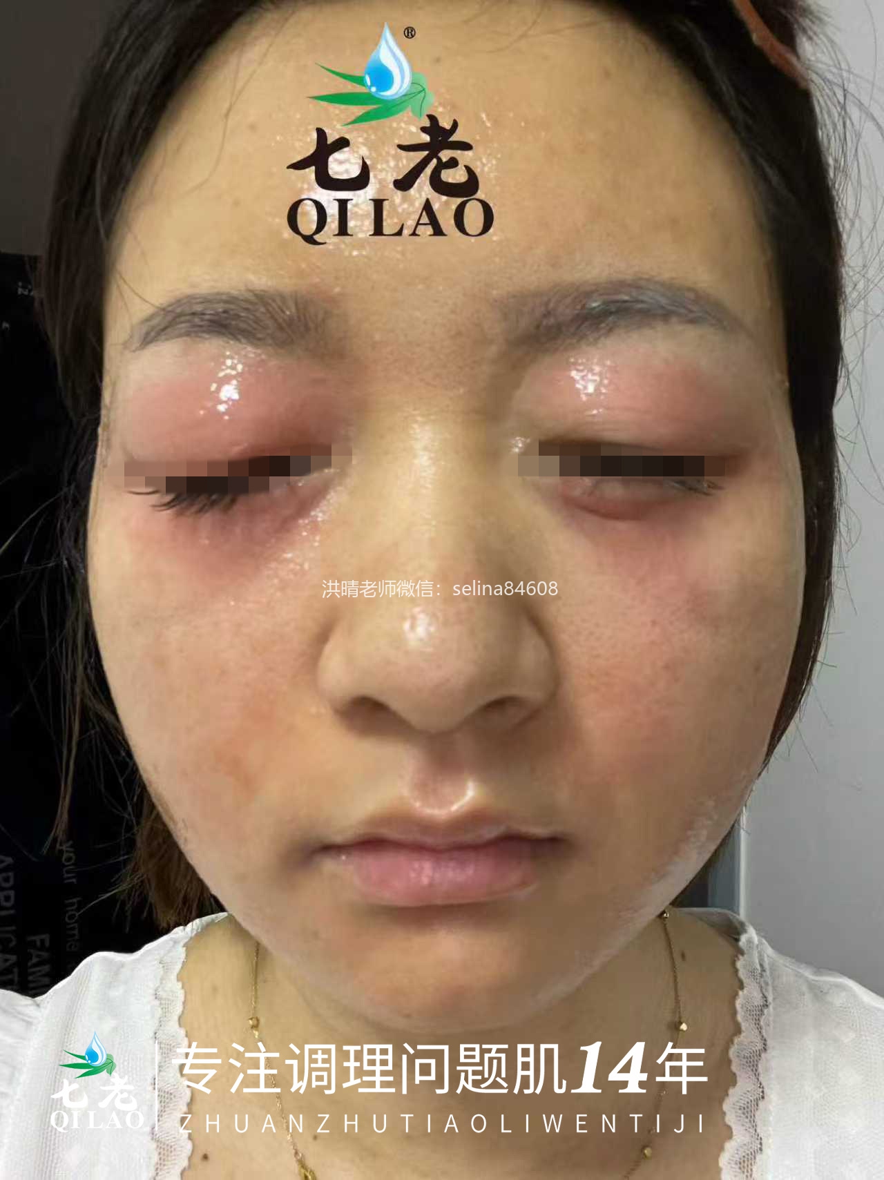 七老皮肤反复过敏红肿痒疹子修护案例