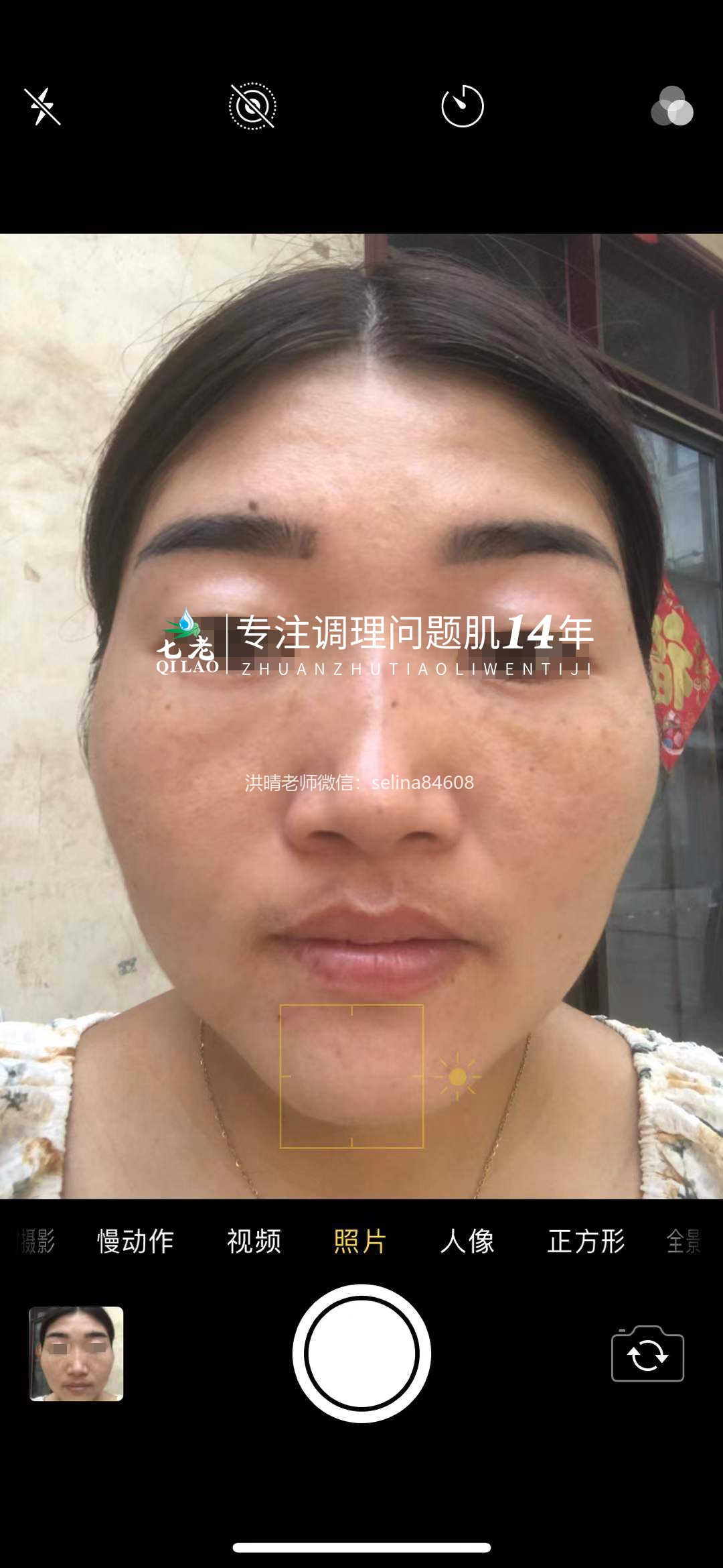 七老激素脸玫瑰痤疮修护案例