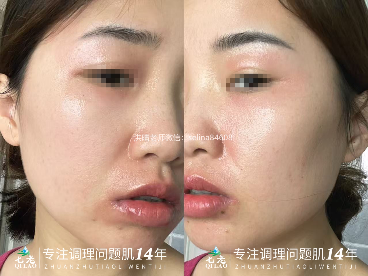 七老敏感肌屏障受损反复长痘爆痘