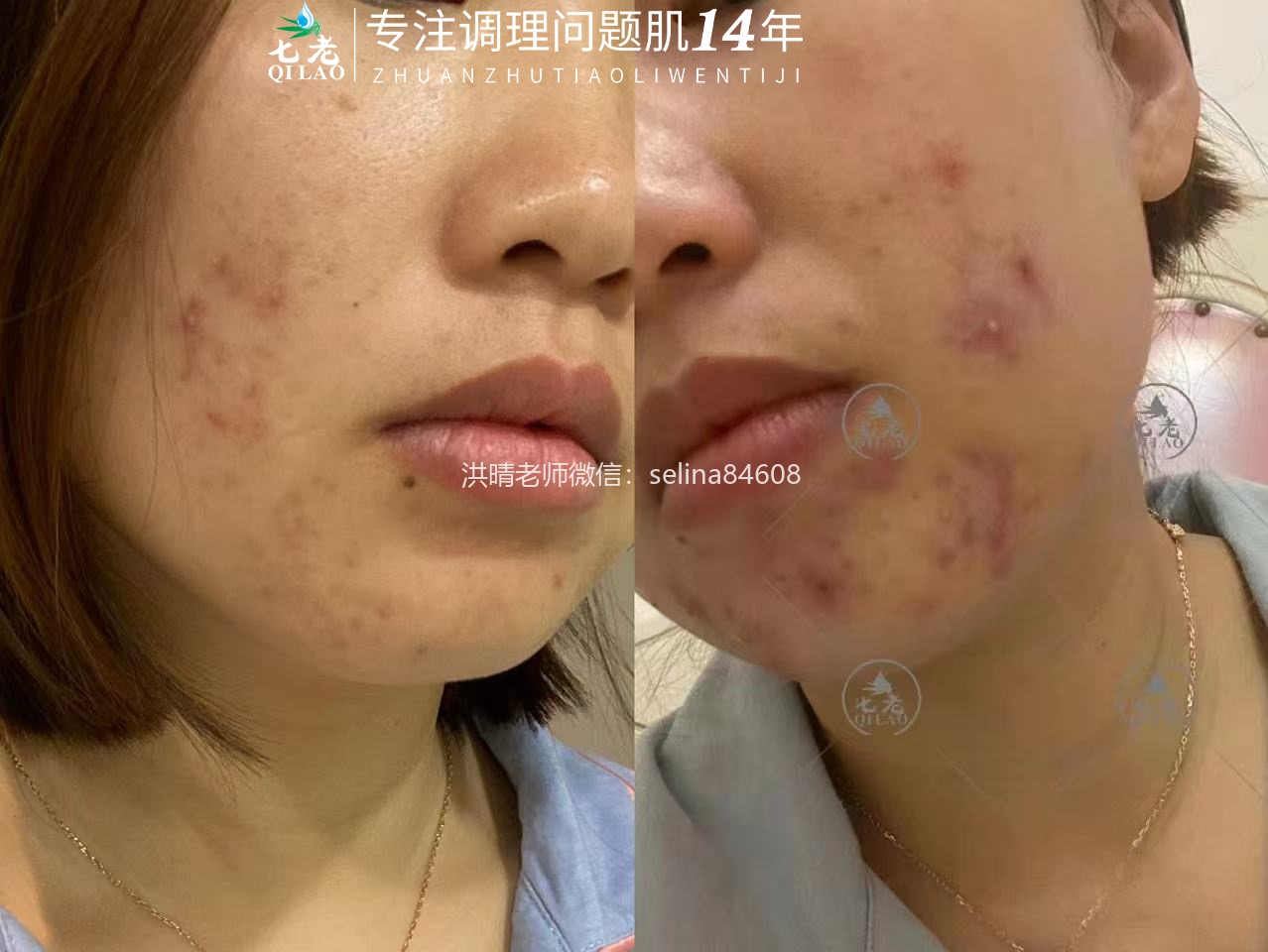 七老敏感肌屏障受损反复长痘爆痘
