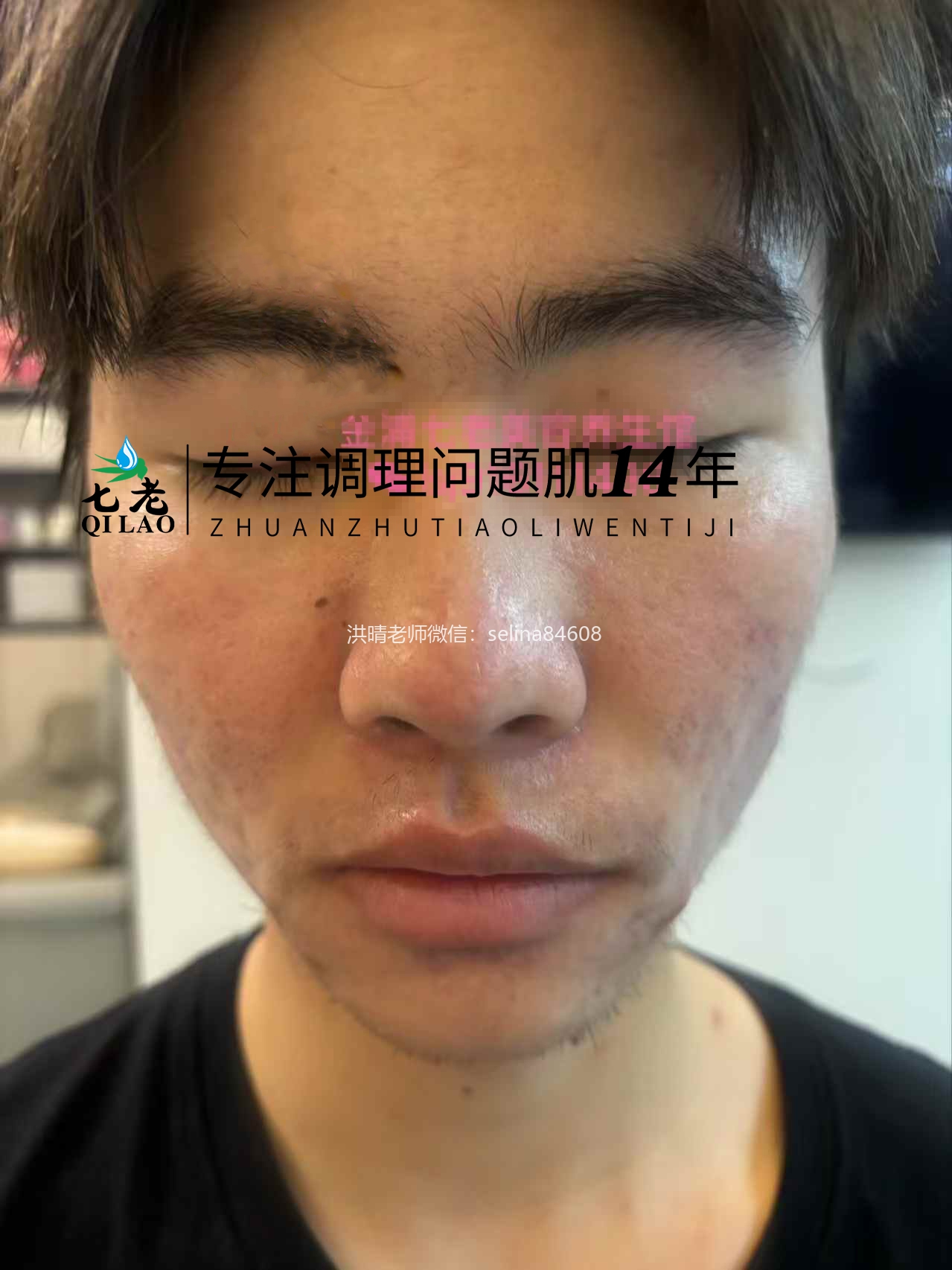 七老激素痘囊肿脓包痘痤疮痘修护案例