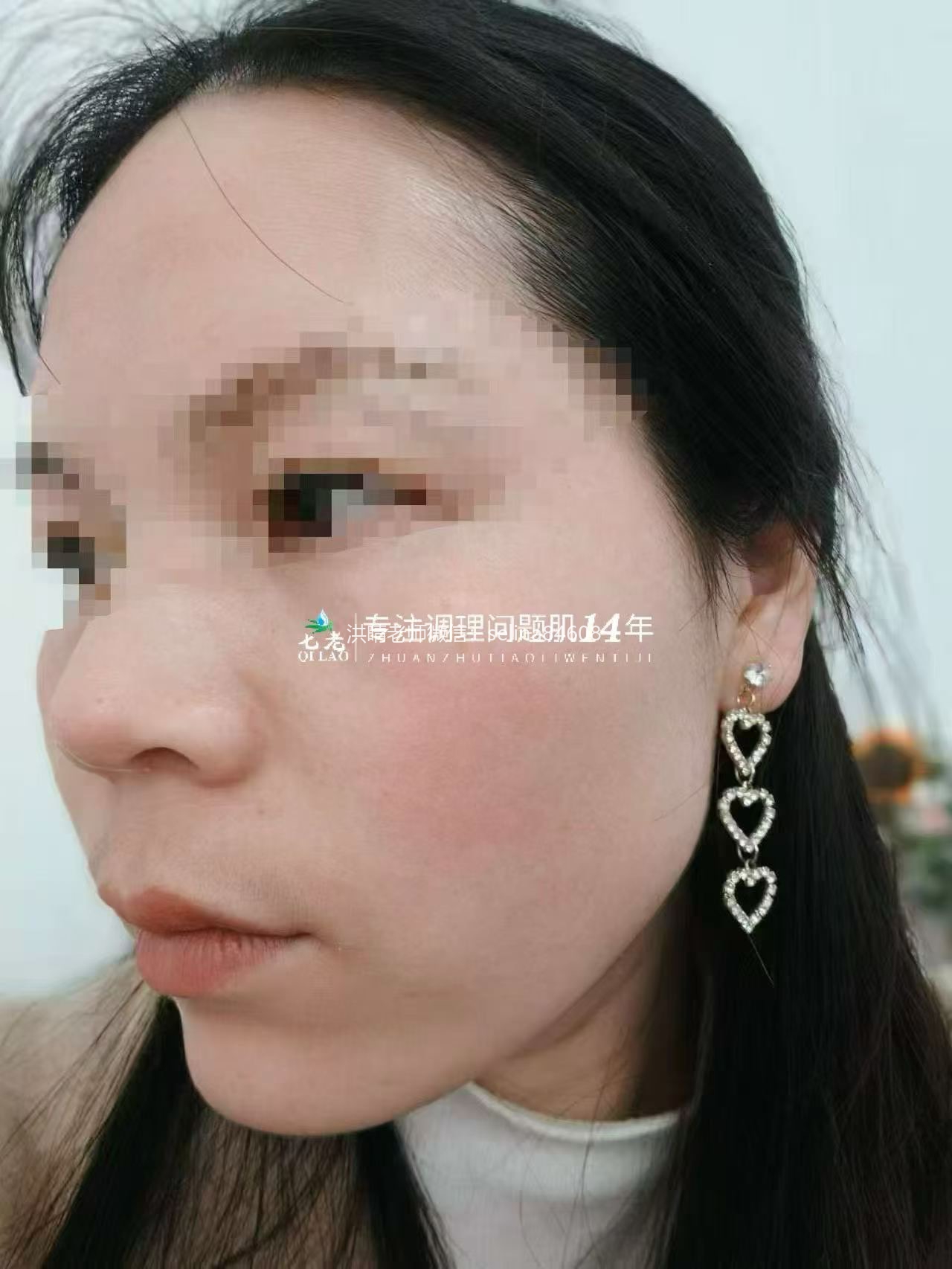 七老过敏脸红干烫痒疹子脱皮修护案例