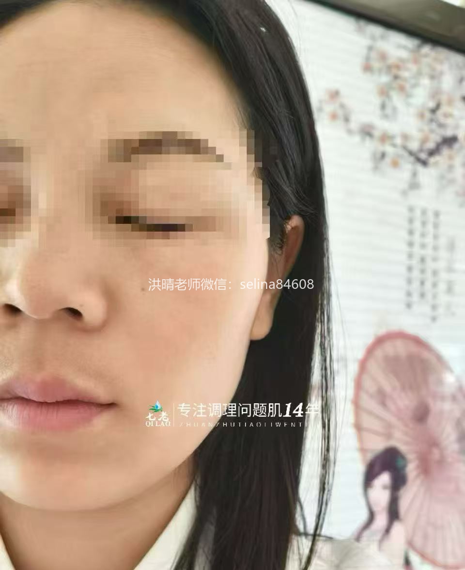 七老过敏脸红干烫痒疹子脱皮修护案例