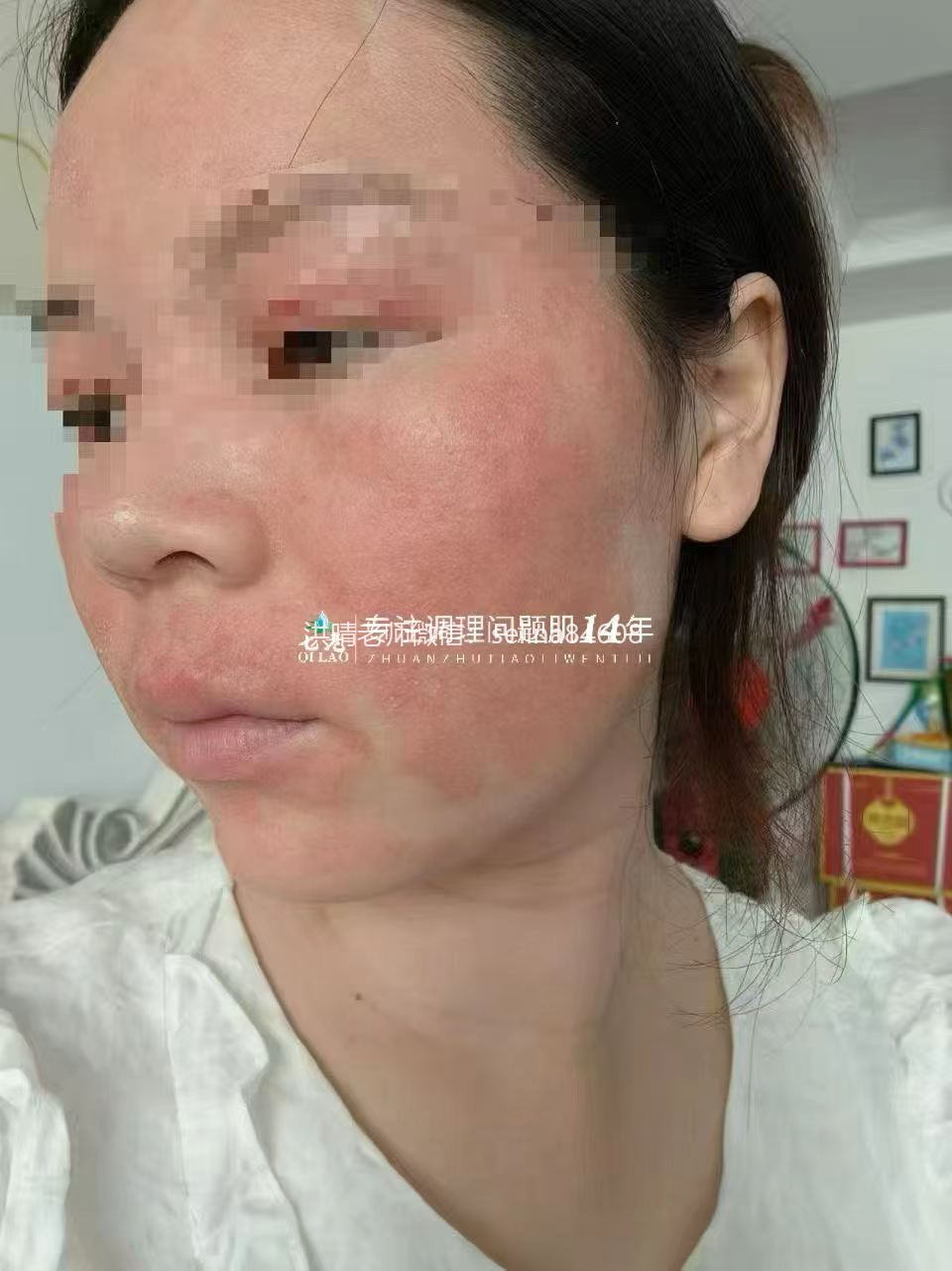 七老过敏脸红干烫痒疹子脱皮修护案例