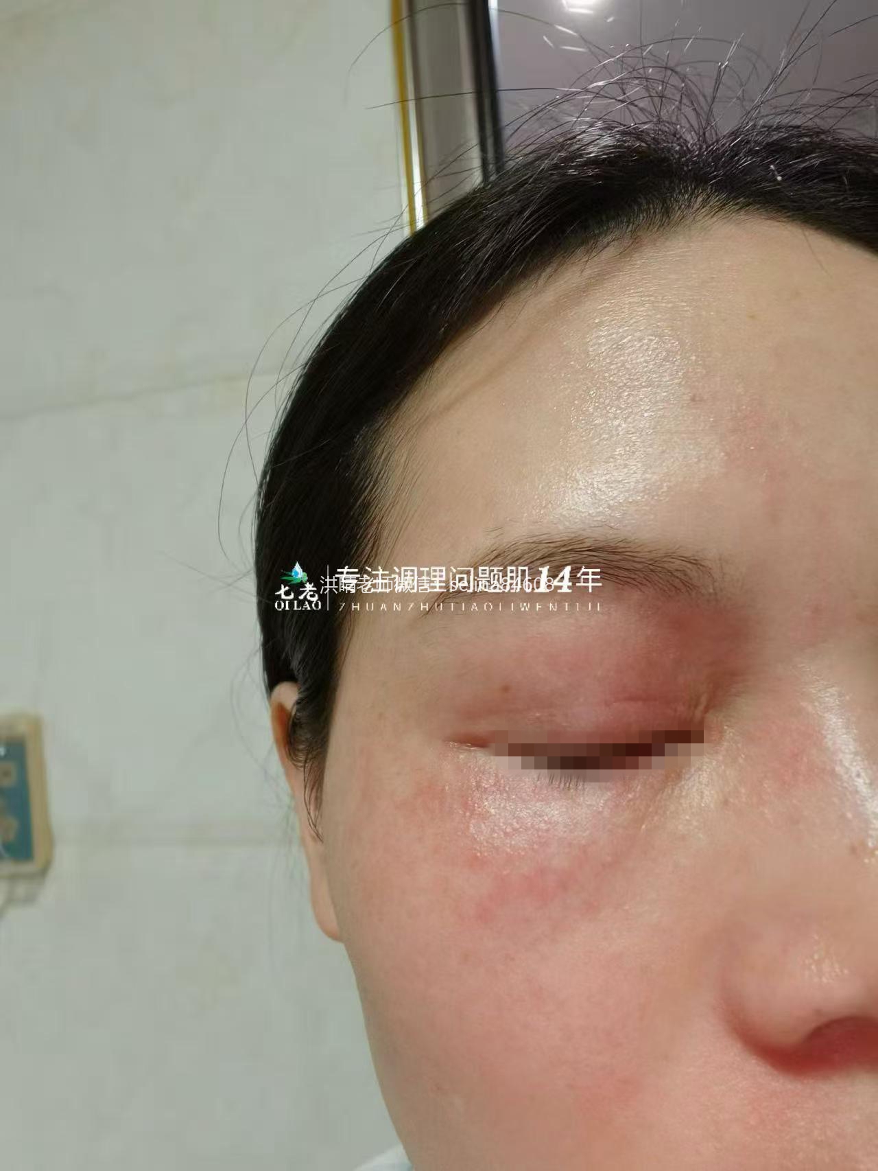 七老过敏脸红干烫痒疹子脱皮修护案例