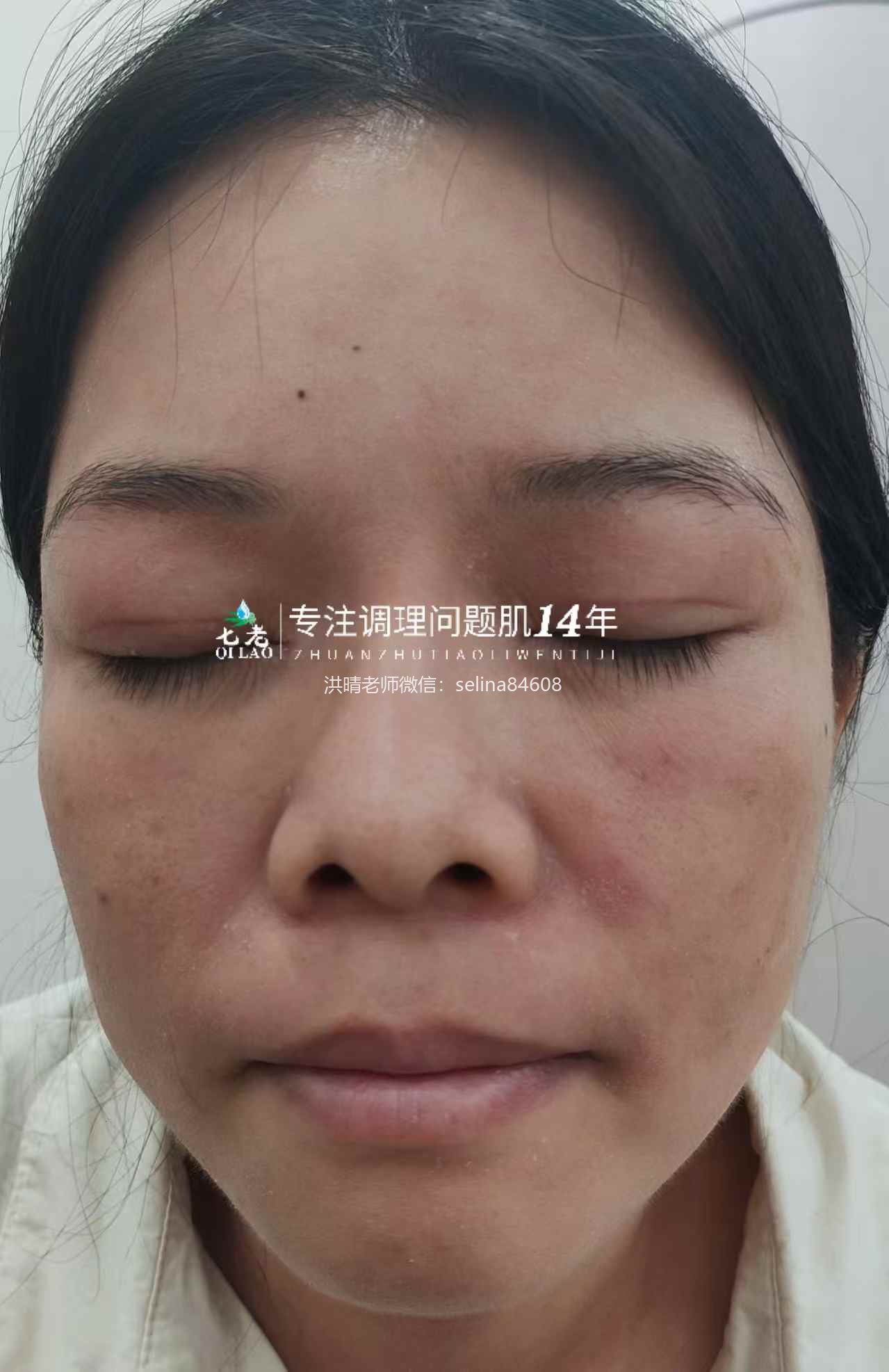 七老皮肤过敏反复红肿烫痒疹子修护案例