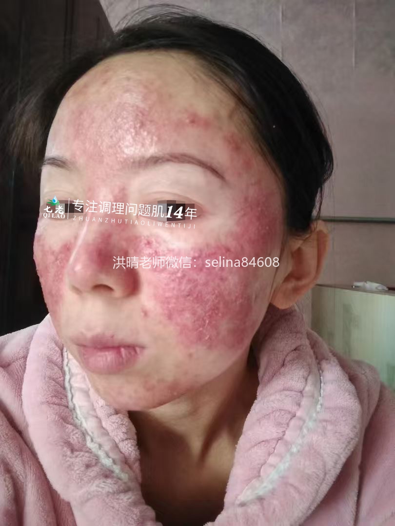 七老激素脸玫瑰痤疮修护成功案例