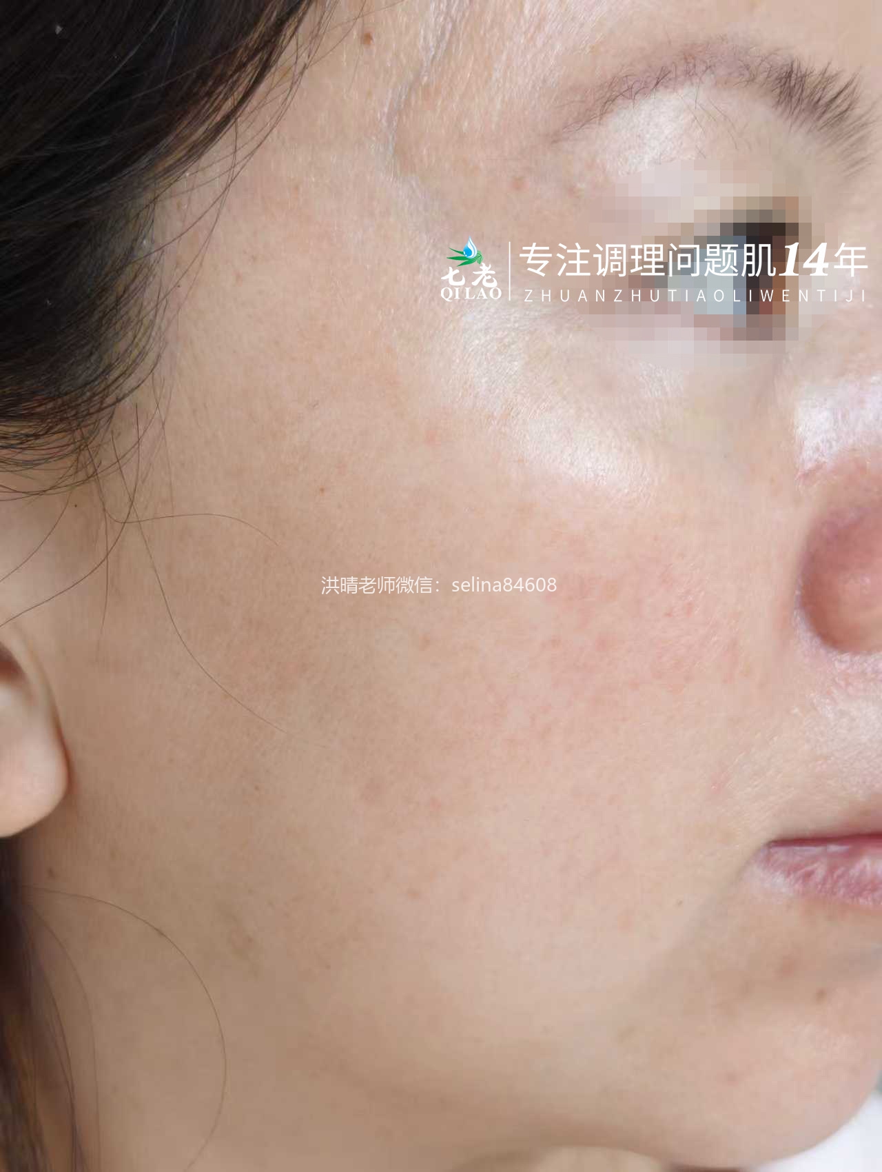 七老激素脸玫瑰痤疮修护成功案例