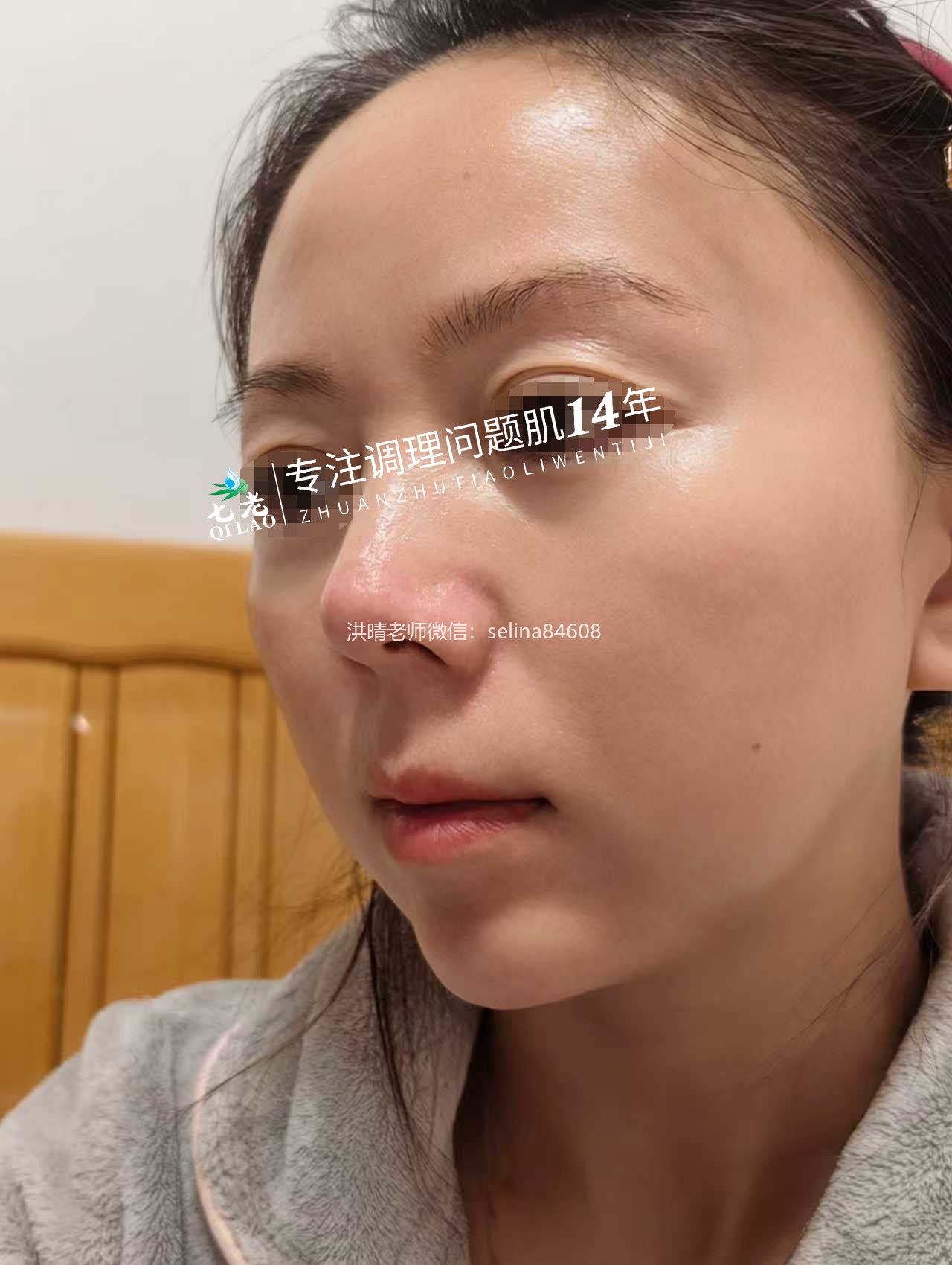 七老激素脸玫瑰痤疮修护成功案例