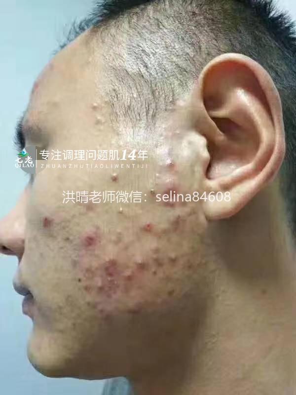七老脓包痘痘修护案例