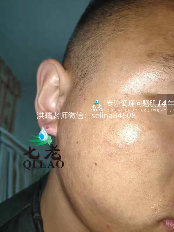七老脓包痘痘修护案例