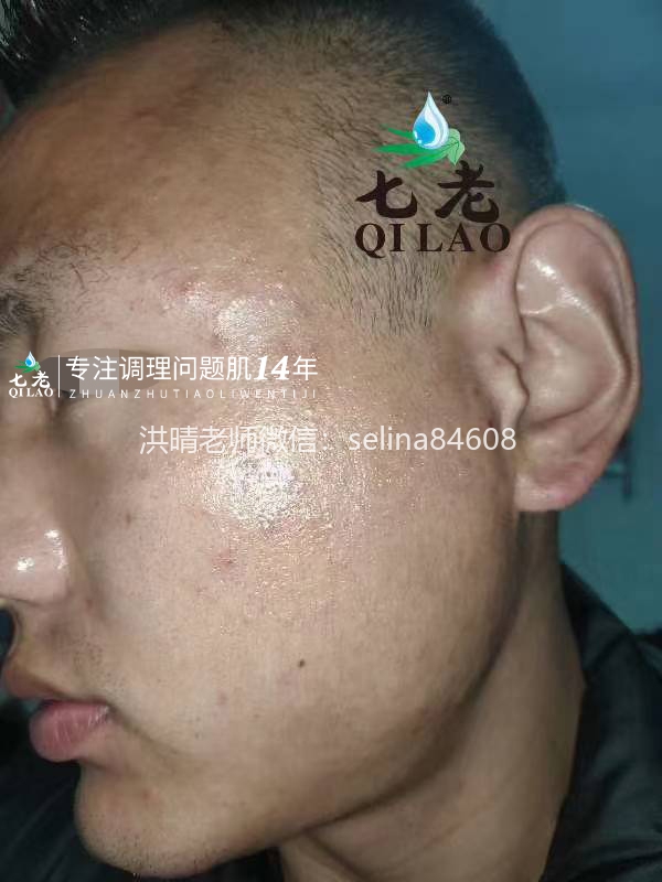 七老脓包痘痘修护案例