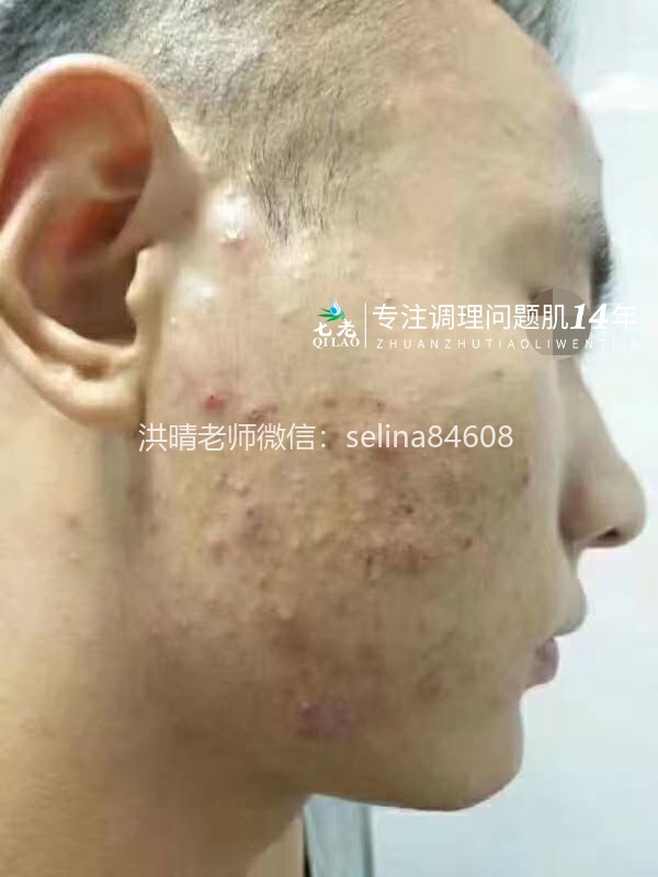 七老脓包痘痘修护案例