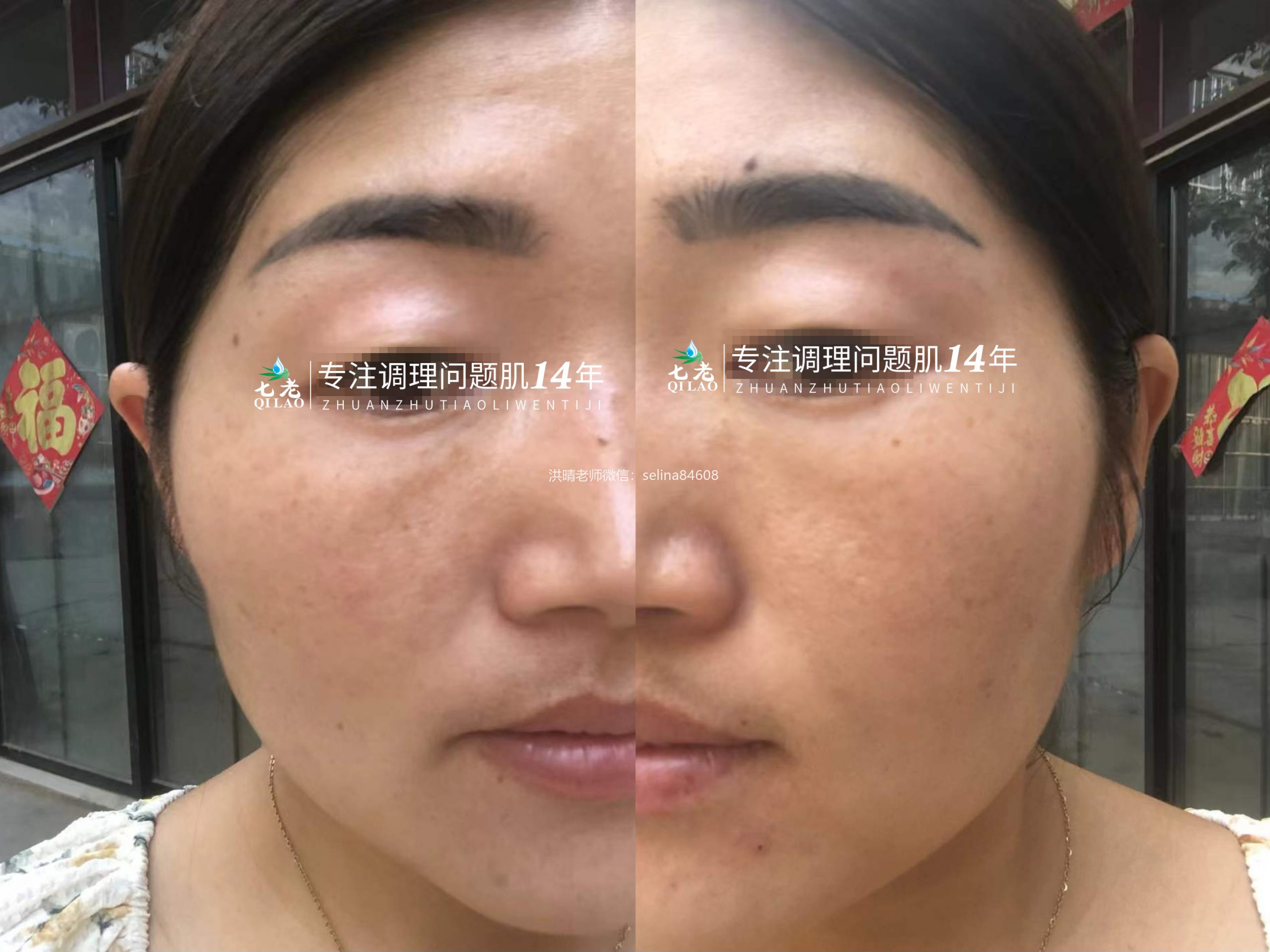 七老激素脸玫瑰痤疮修护案例