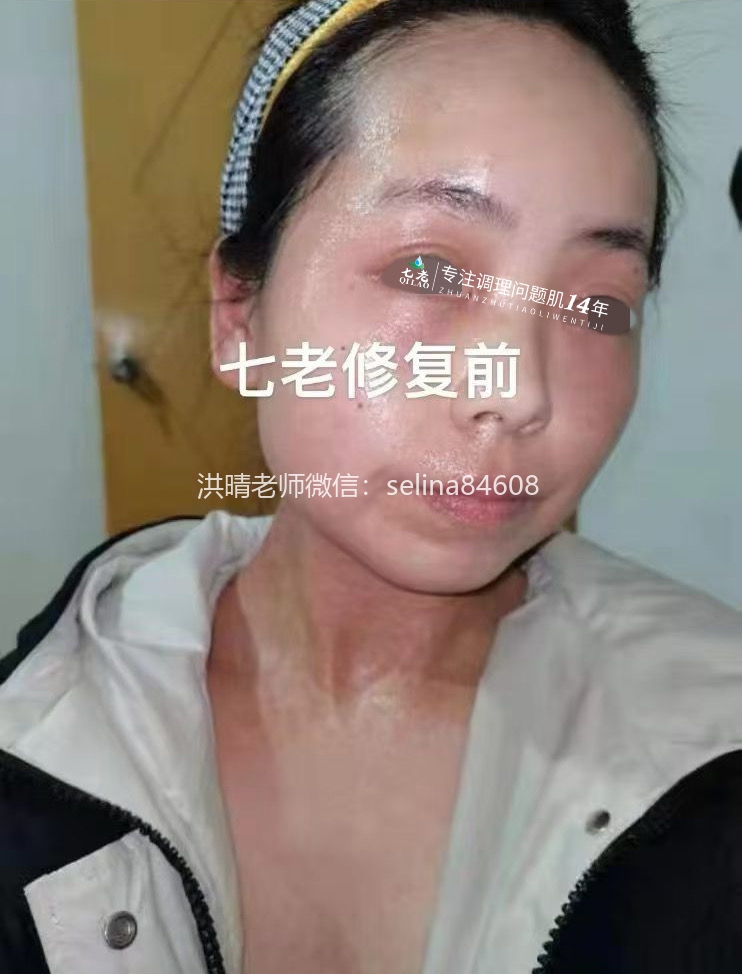 七老激素脸修护案例