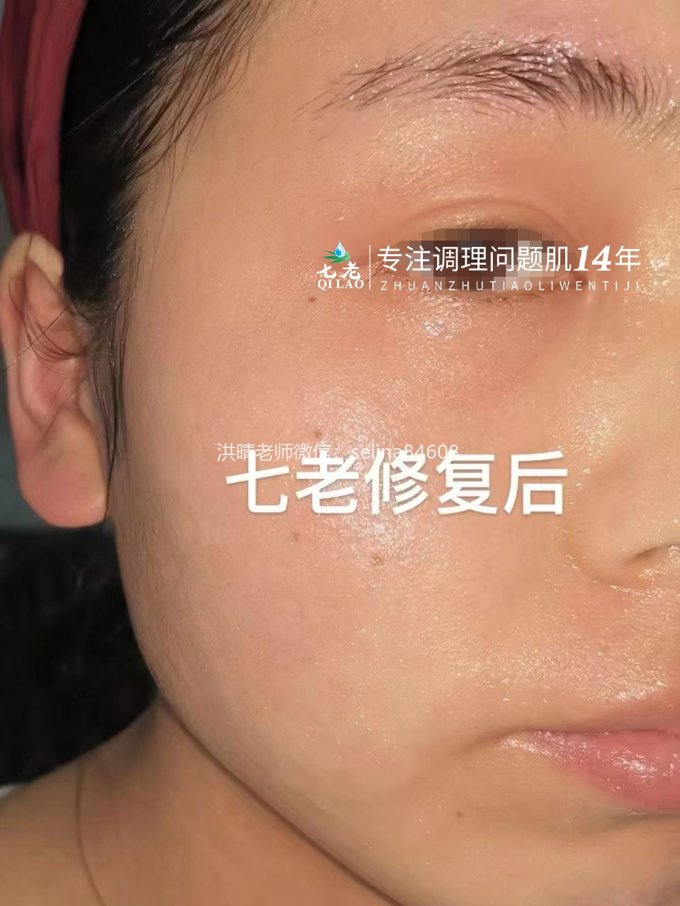 七老激素脸修护案例