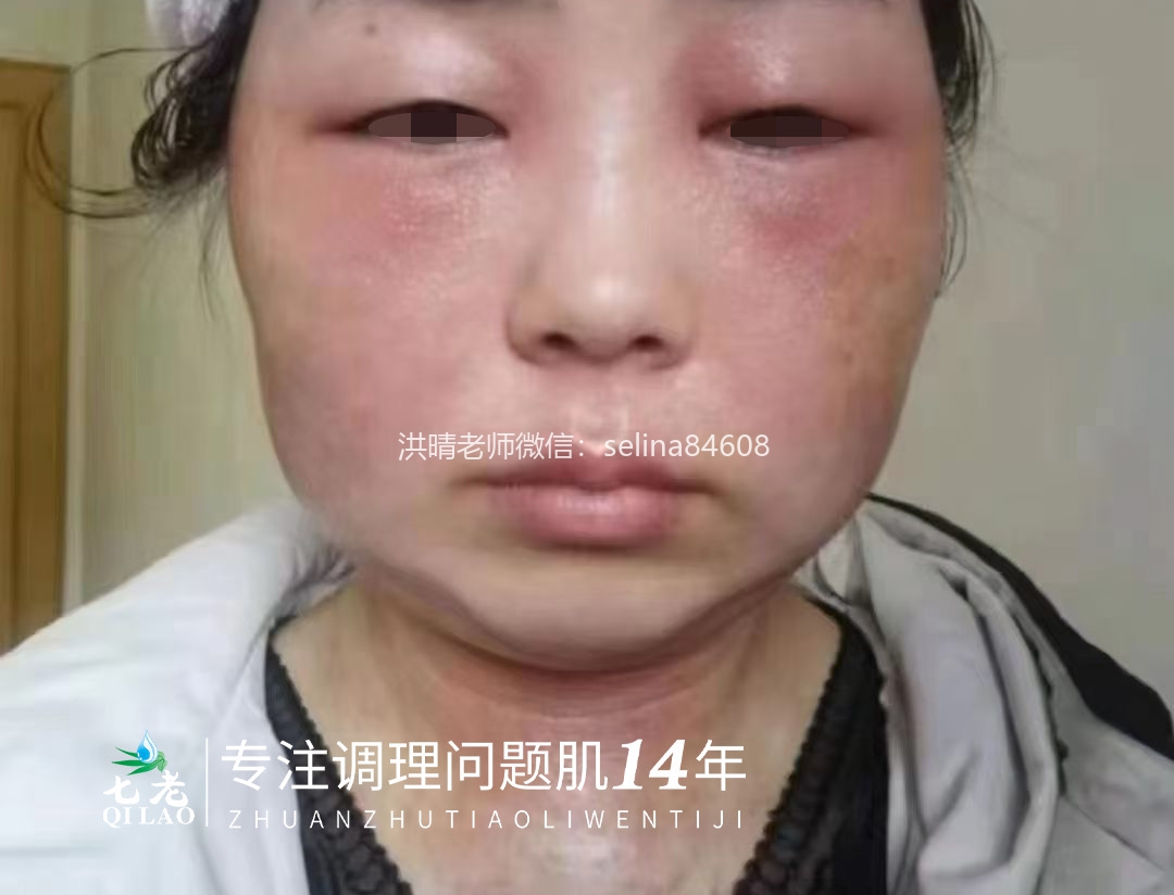 七老激素脸修护案例