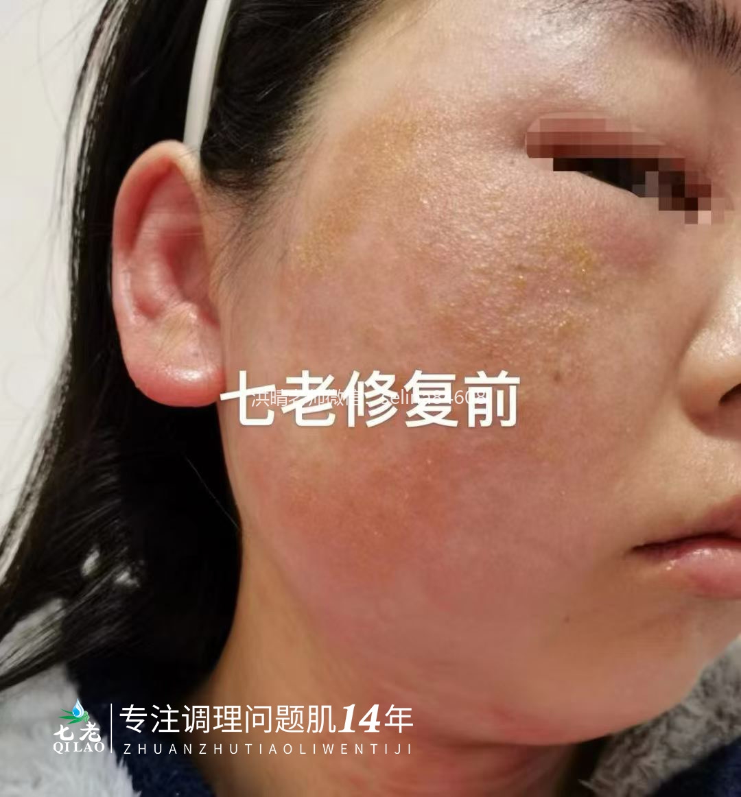 七老激素脸修护案例