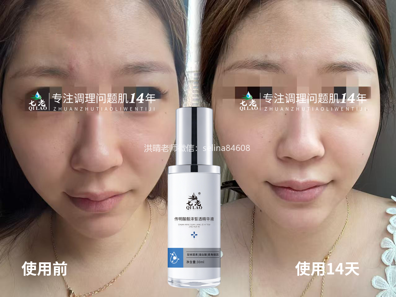 七老传明酸→慢性炎症，色沉暗黄用它错不了