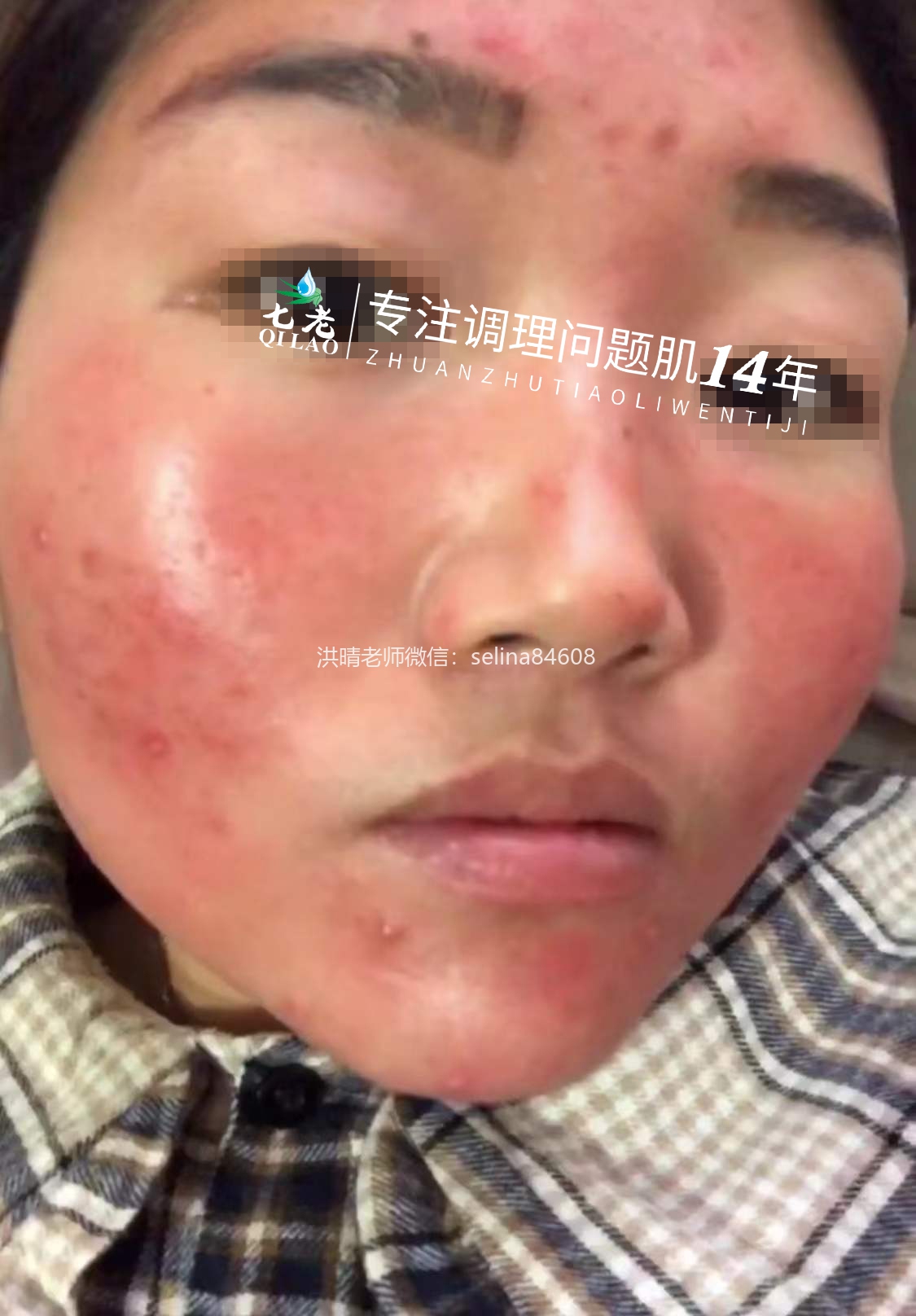 七老激素脸玫瑰痤疮修护案例