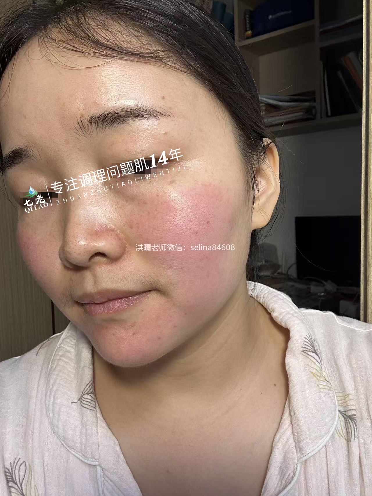 七老屏障受损敏感过敏红肿痒修护案例