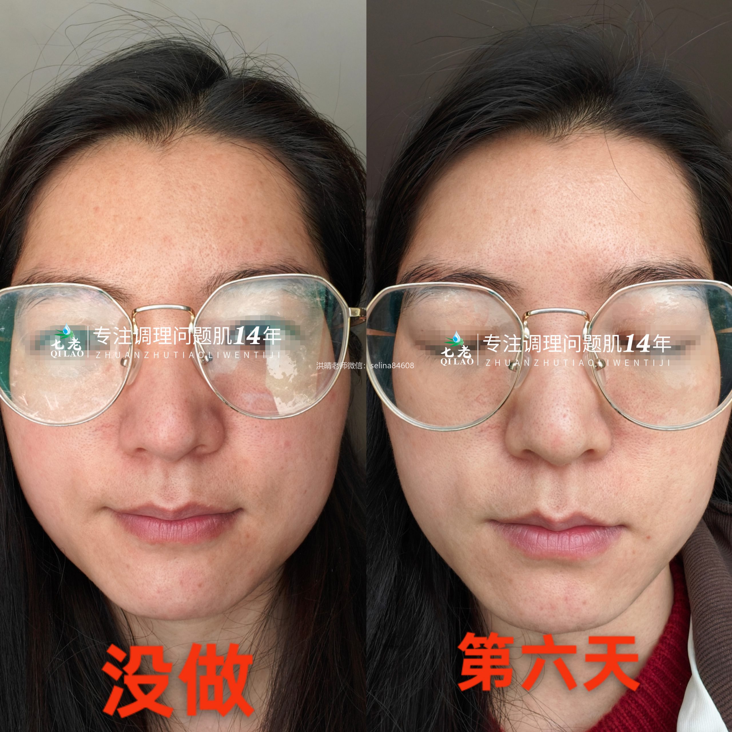 七老胶原水光→修护紧致抗衰绝绝子