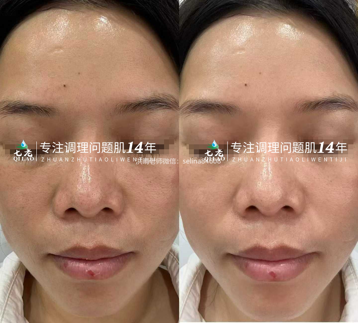 七老皮肤过敏反复红肿烫痒疹子修护案例