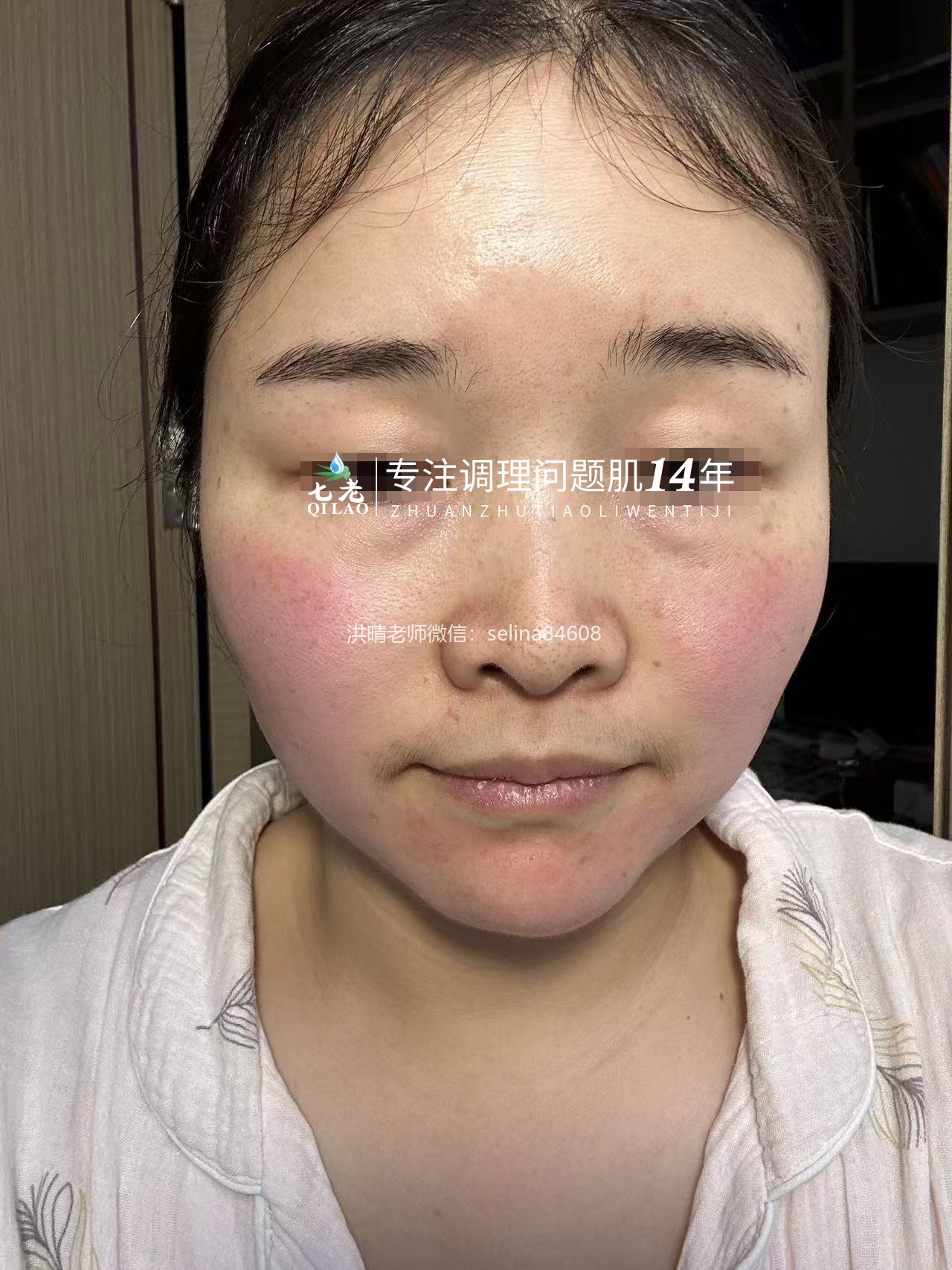 七老屏障受损敏感过敏红肿痒修护案例