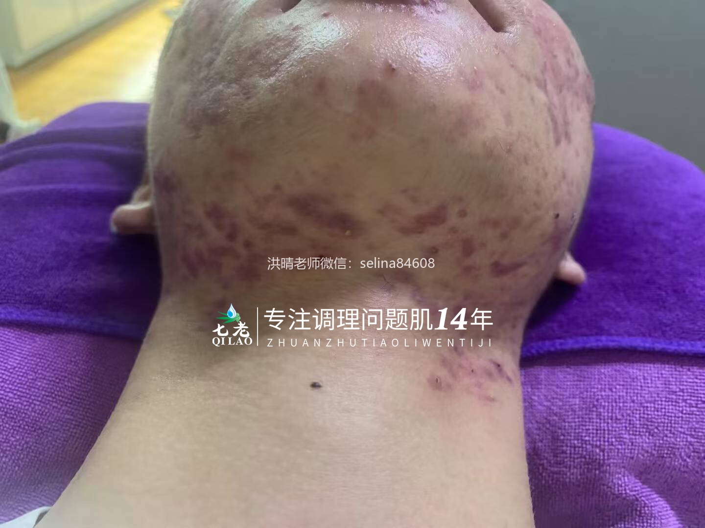 七老激素痘囊肿脓包痘痤疮痘修护案例