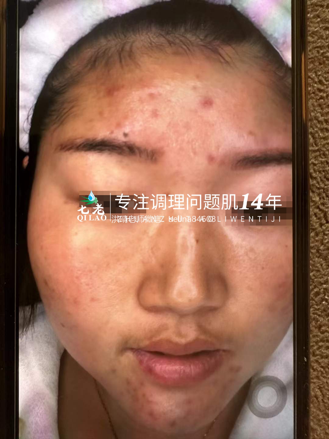 七老激素脸玫瑰痤疮修护案例