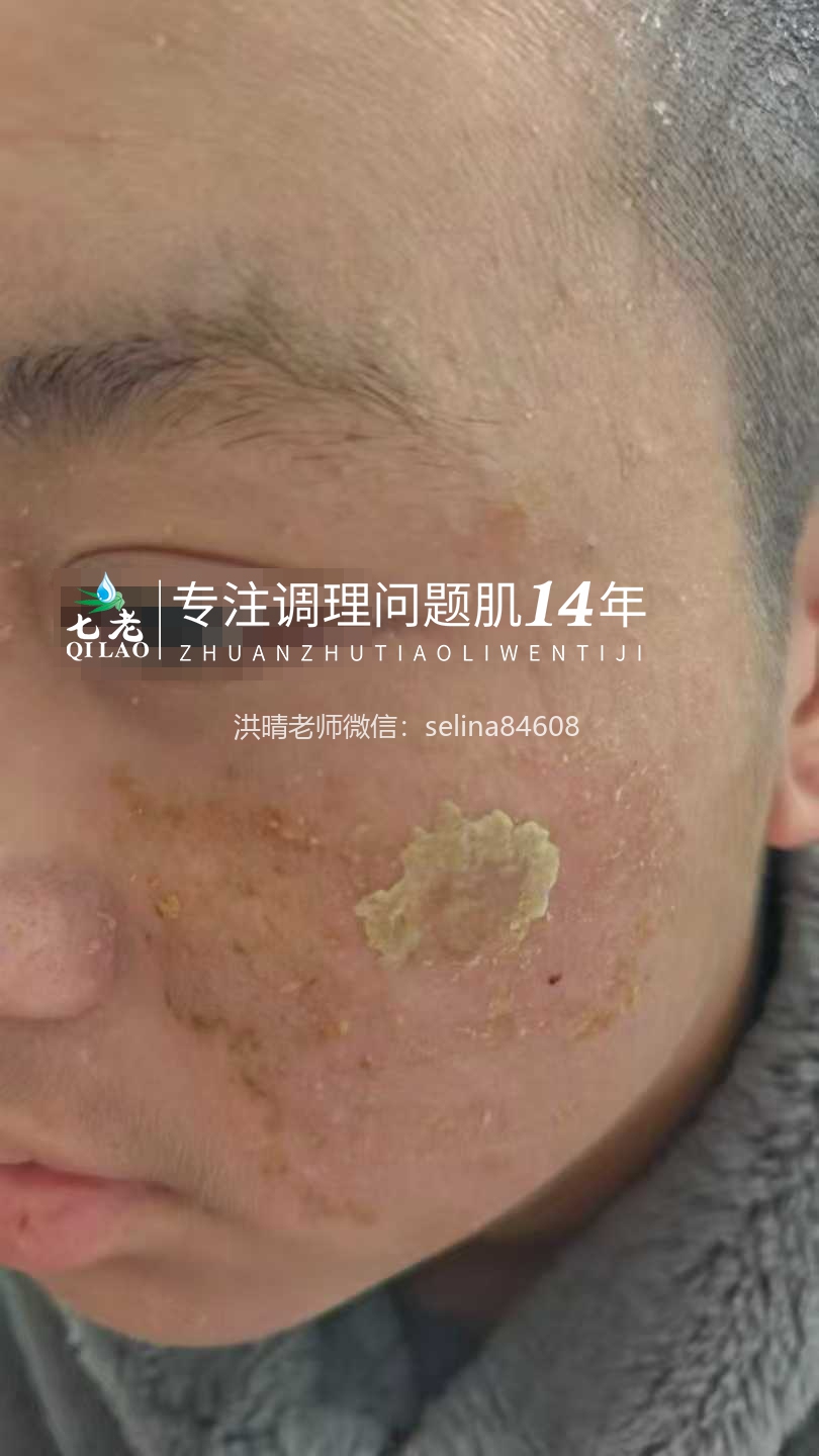 七老严重激素脸流黄水结痂渗液修护记录✍️