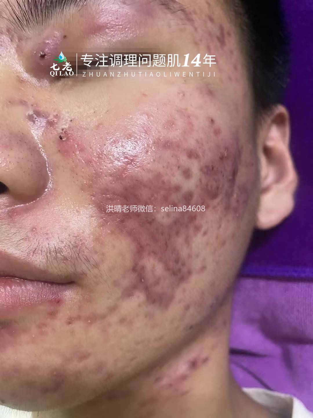 七老激素痘囊肿脓包痘痤疮痘修护案例