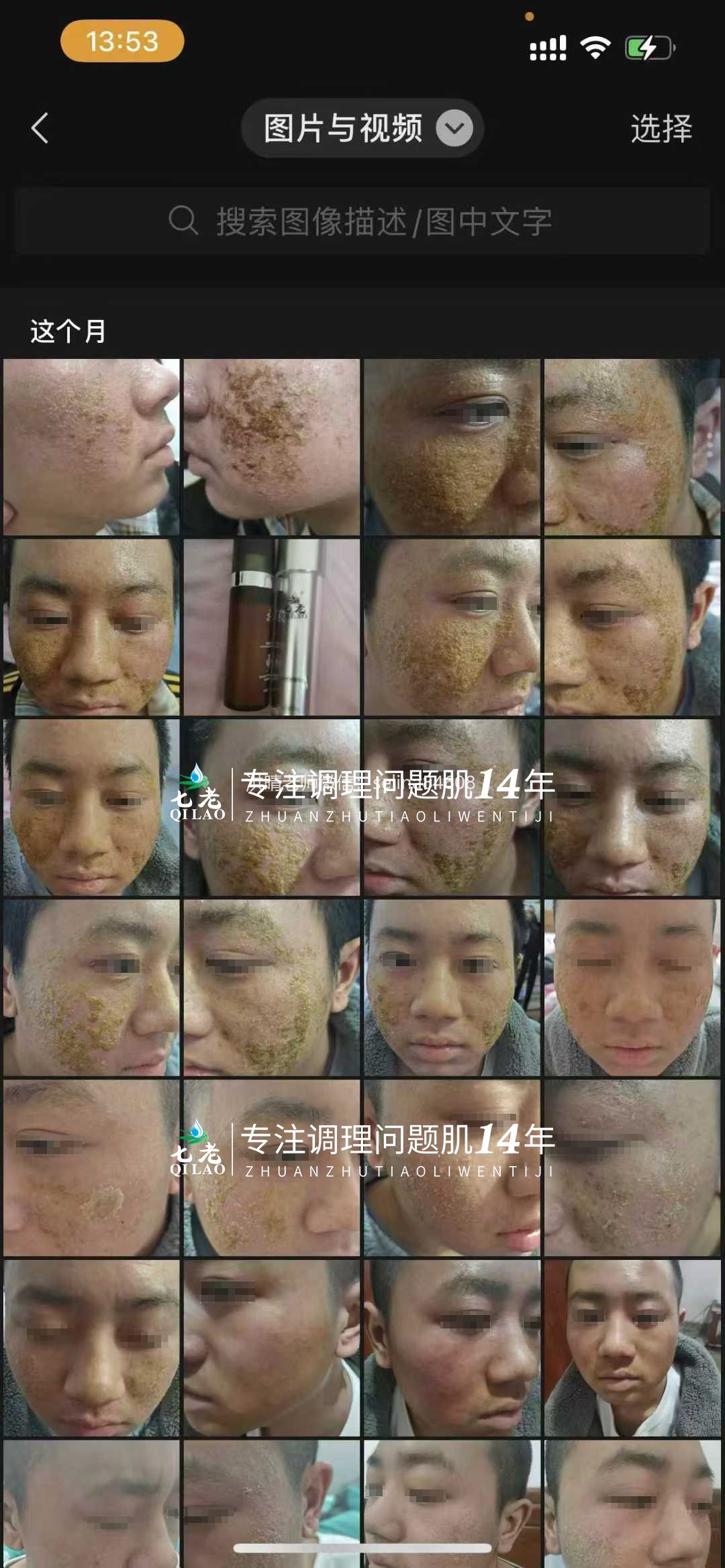 七老严重激素脸流黄水结痂渗液修护记录✍️