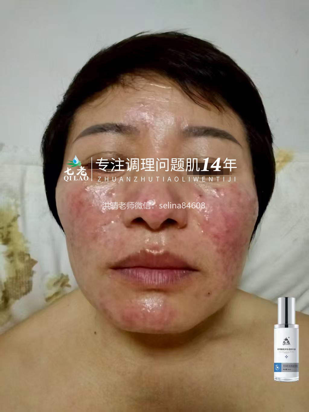 七老玫瑰痤疮➕激素脸修护案例，三十多年的激素脸玫瑰痤疮