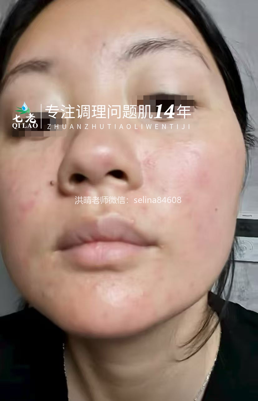 七老激素脸玫瑰皮修护案例