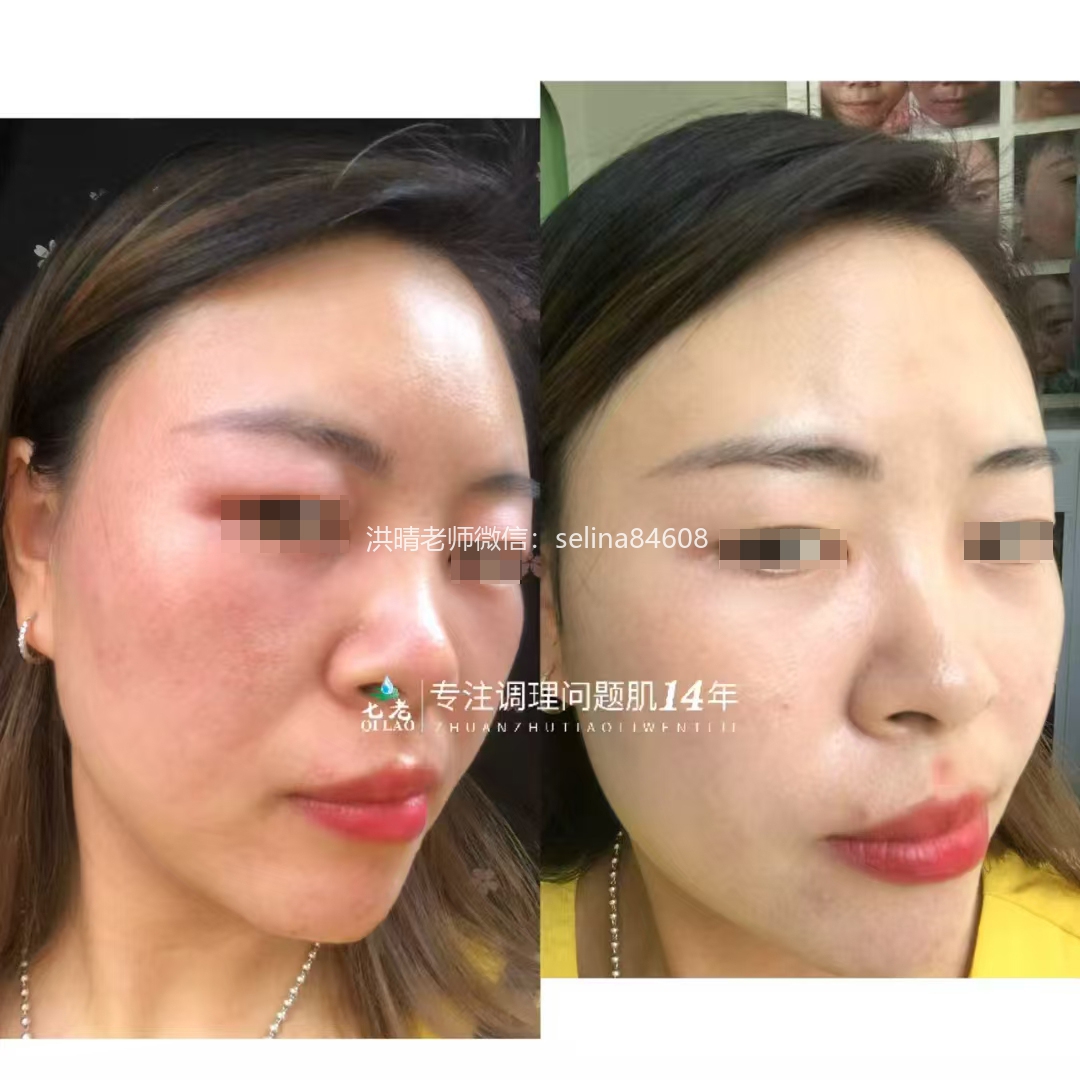 七老脖子眼周红肿痒疹子反复过敏修护案例