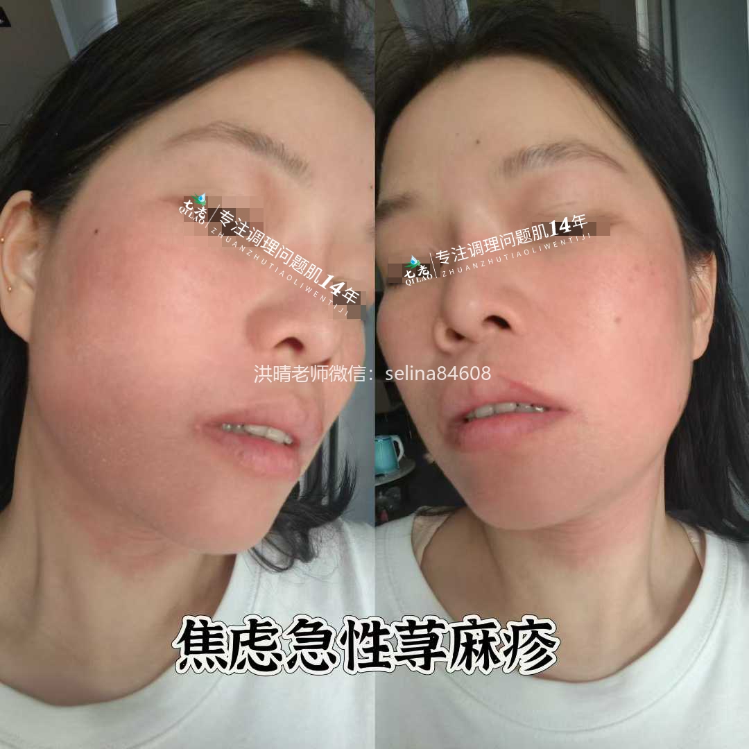 七老皮肤过敏反复红肿烫痒疹子修护案例