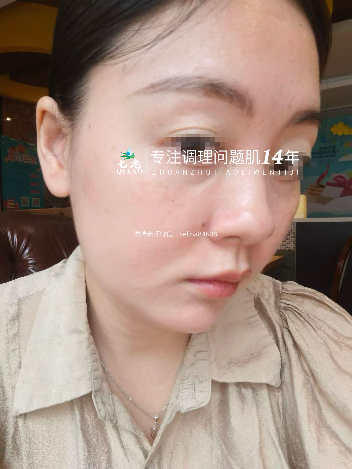 七老激素脸玫瑰皮修护案例