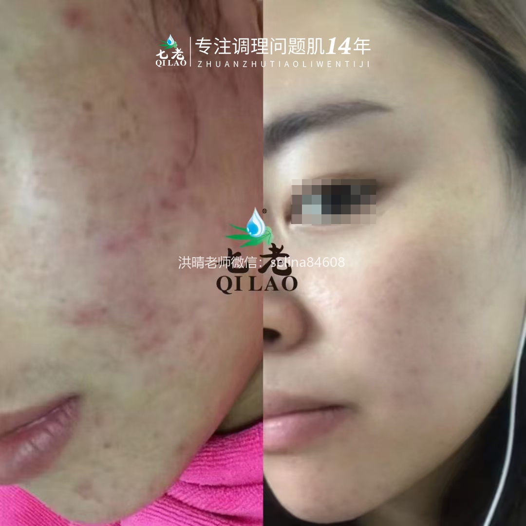 七老脖子眼周红肿痒疹子反复过敏修护案例