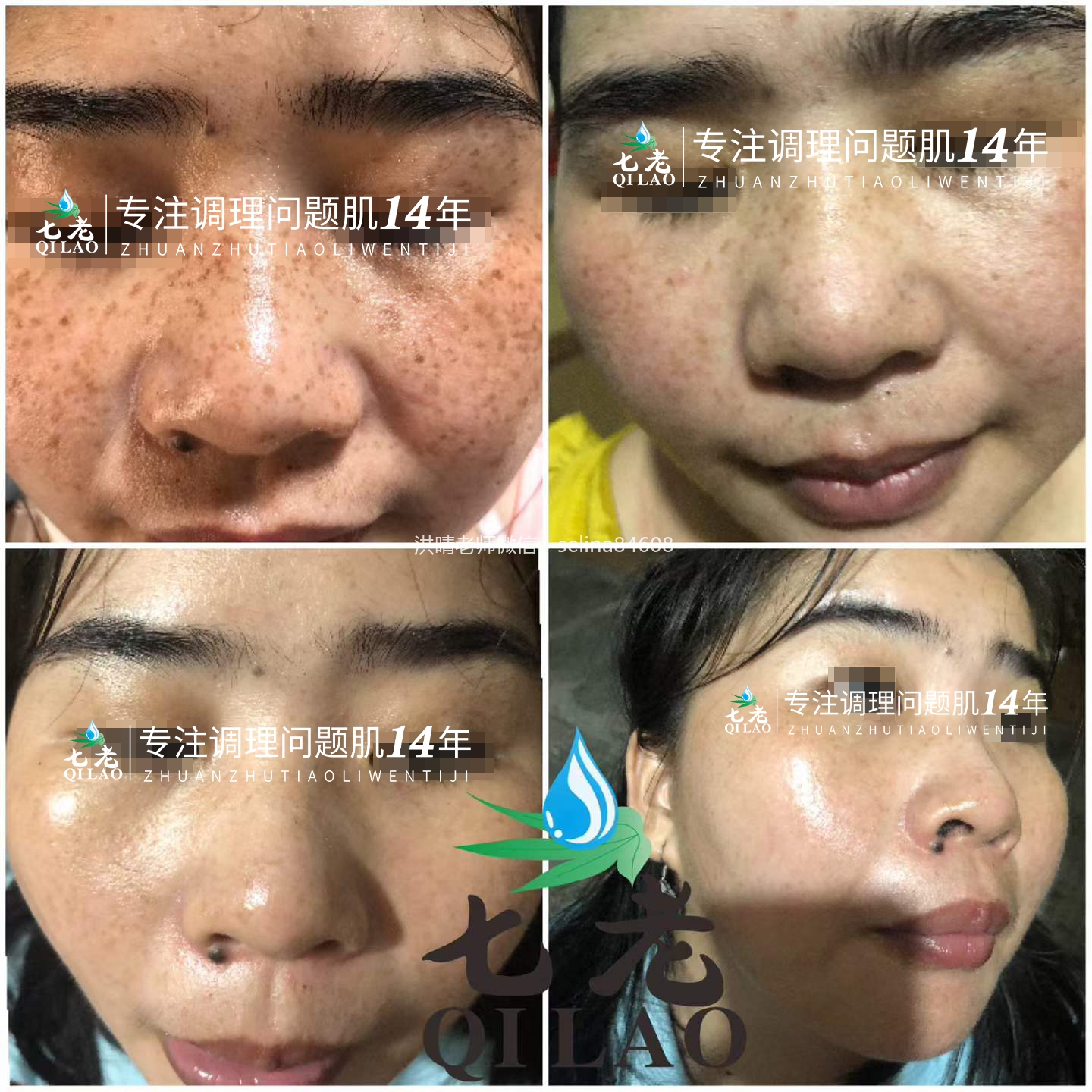 七老发红敏感斑点修护案例