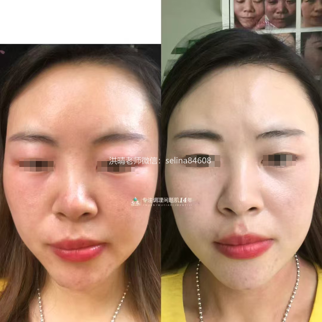 七老脖子眼周红肿痒疹子反复过敏修护案例