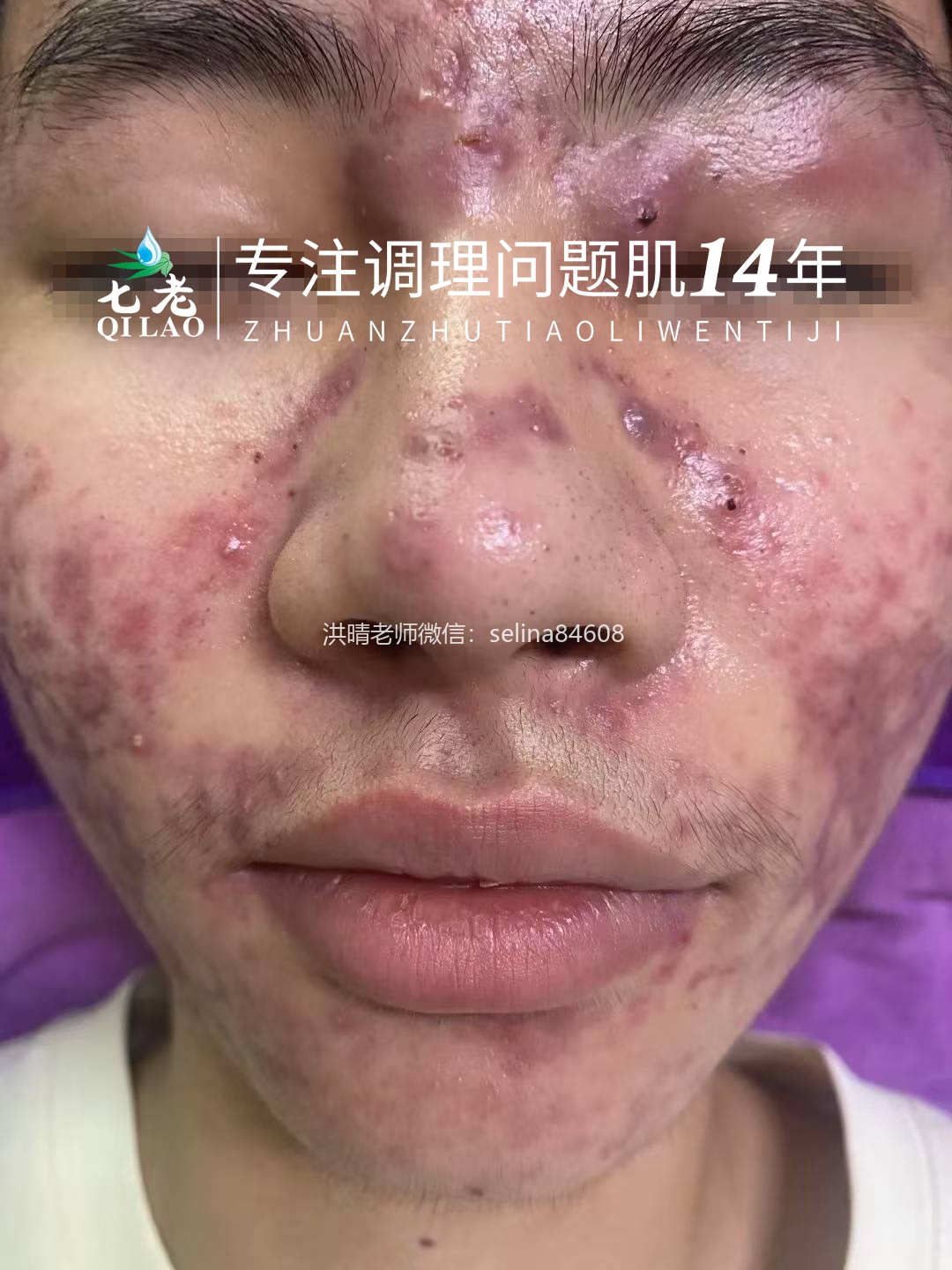 七老激素痘囊肿脓包痘痤疮痘修护案例