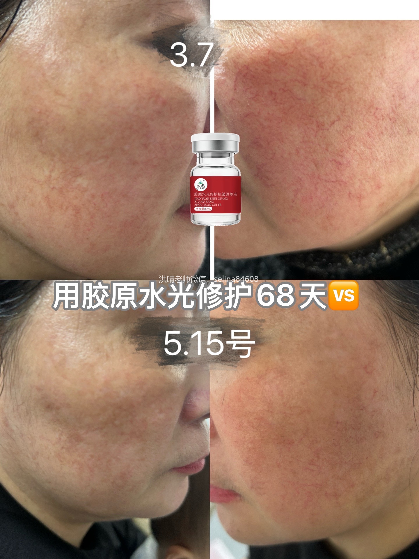 七老红血丝角质层薄红烫皮修护案例