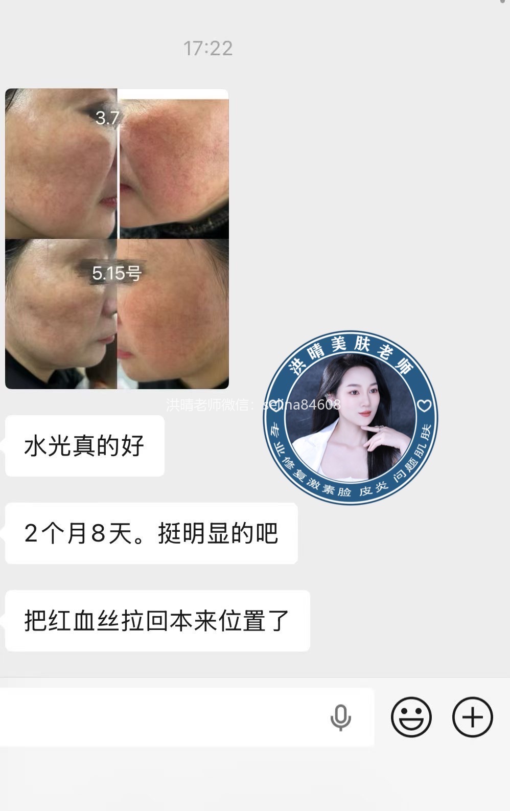 七老红血丝角质层薄红烫皮修护案例