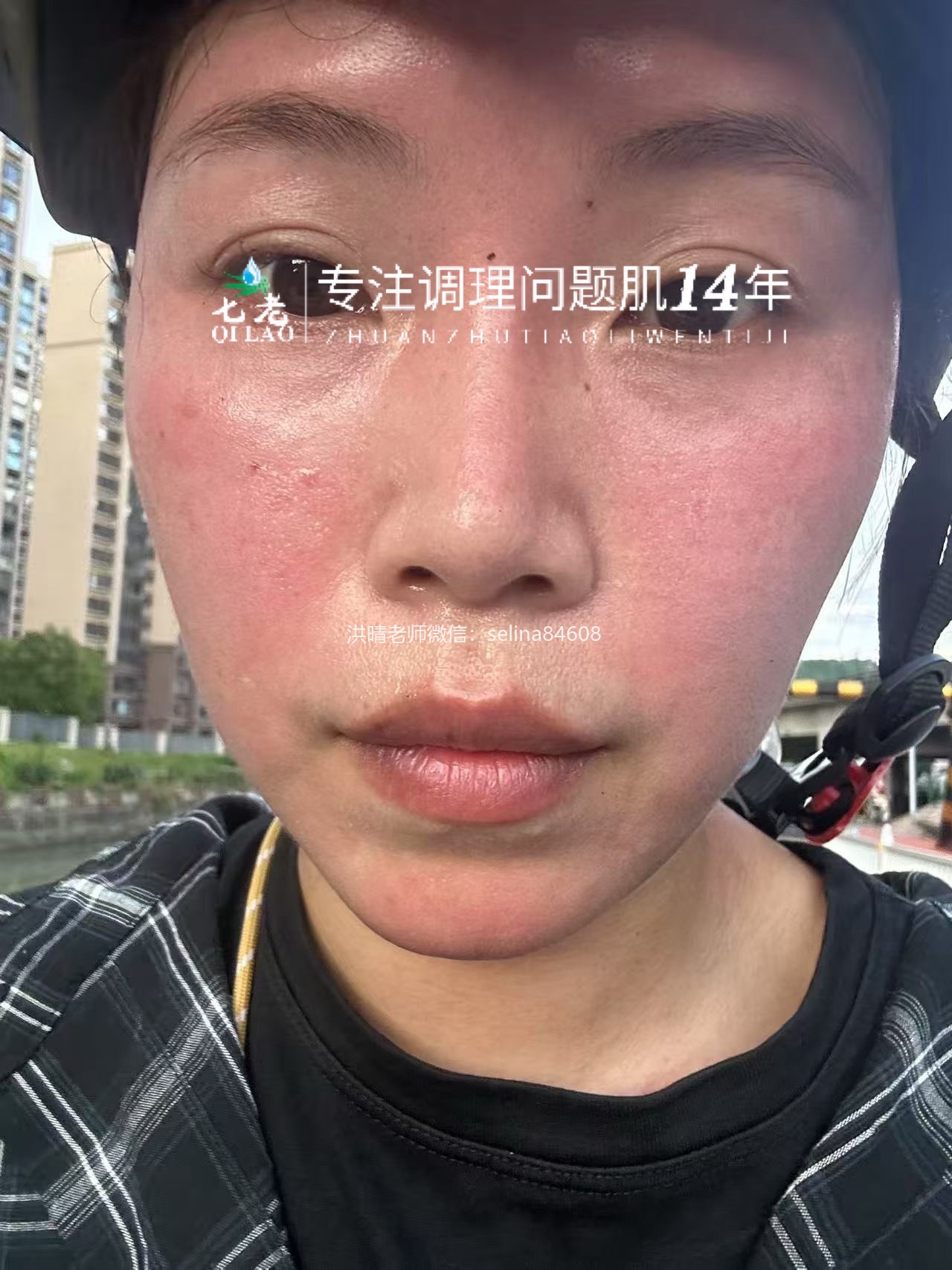 七老发红发烫红烫肌修护案例